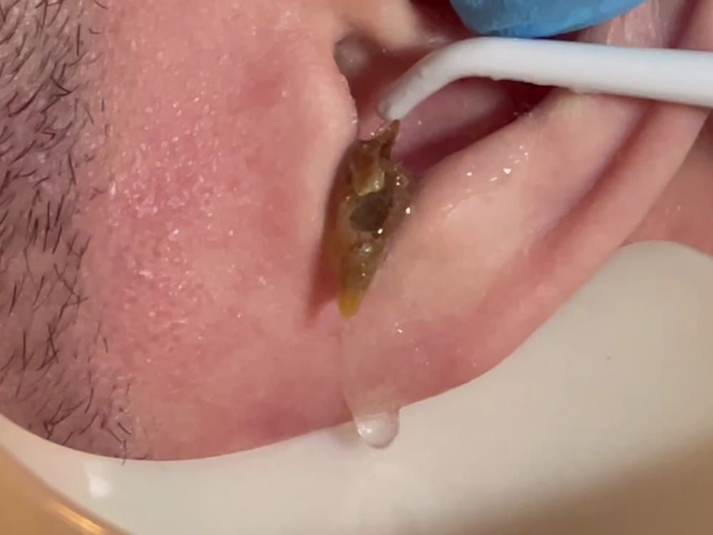 A plug of ear wax coming out with the warm water during ear irrigation at Happy Ears
