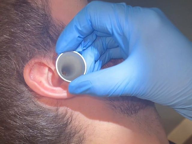 A gloved hand placing an ear speculum before manual ear wax removal