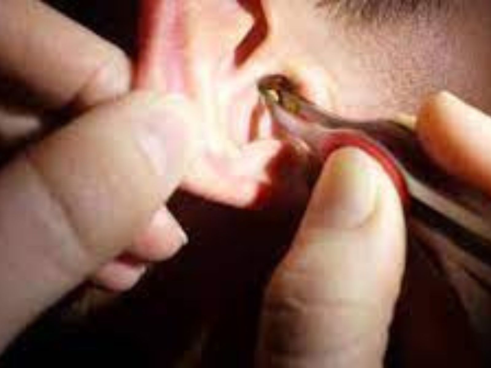 Manual earwax removal for a patient from Burton Joyce