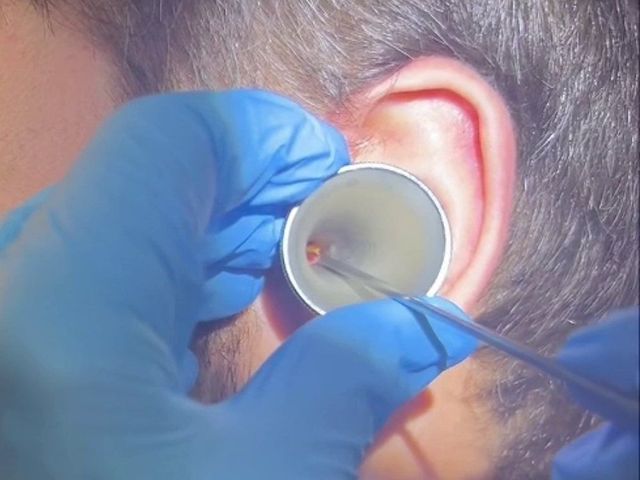 Close-up of microsuction ear wax removal through a speculum at Happy Ears
