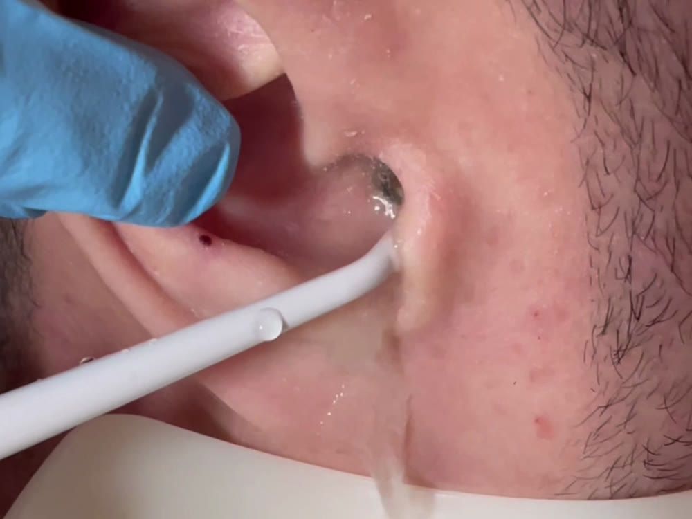 A gloved hand holding the ear back during warm water ear irrigation at Happy Ears in Nottingham