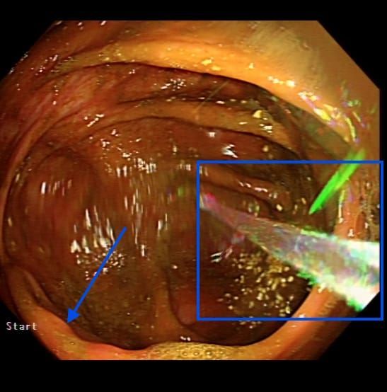 Faecal (poo) residue coating the lining of the large intestine making it very hard to assess properly