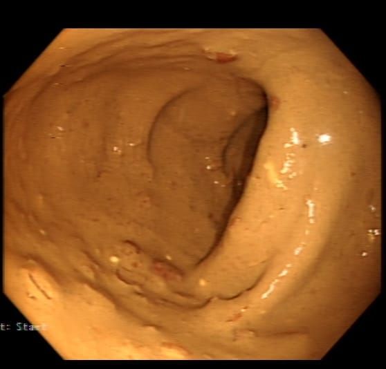 Poor bowel preparation in a paediatric colonoscopy