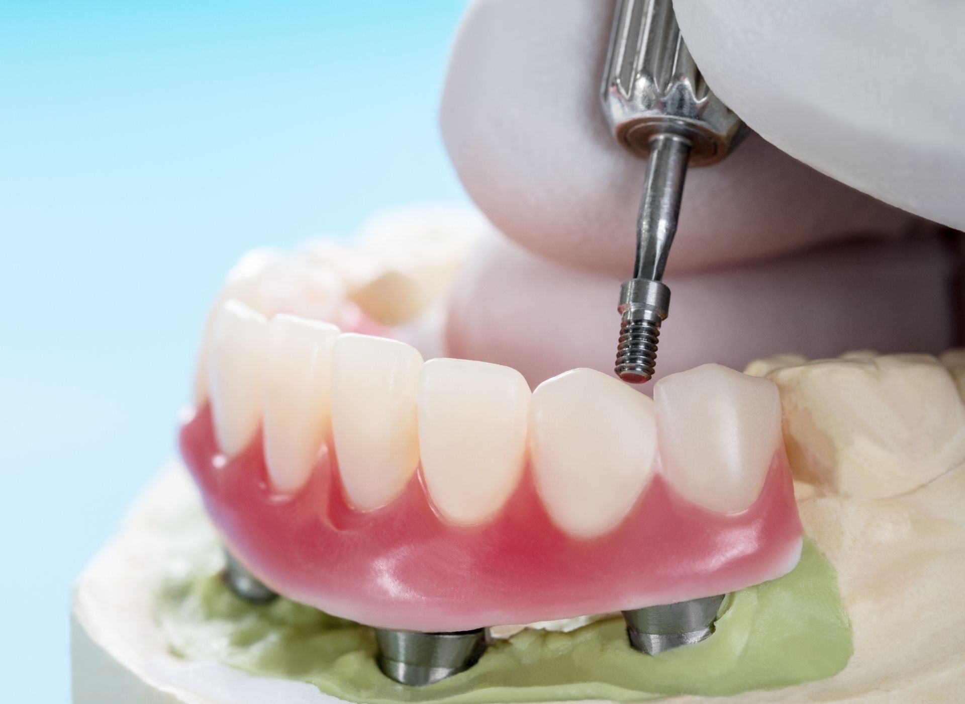 A gloved hand uses a torque driver to tighten a dental implant screw on a prosthetic bridge model.