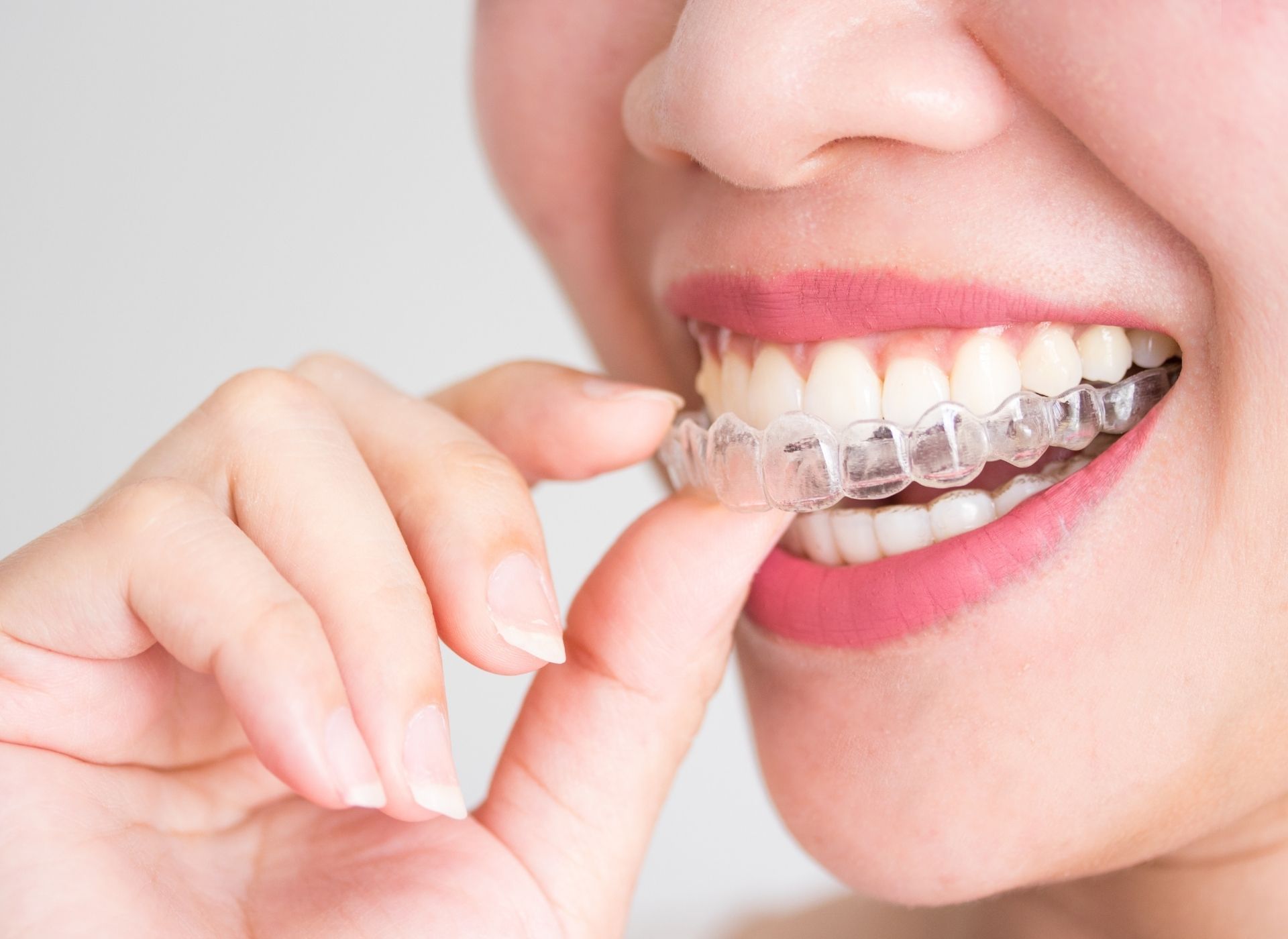 Close-up of a person's mouth as they insert a clear plastic aligner onto their upper teeth with their finger.