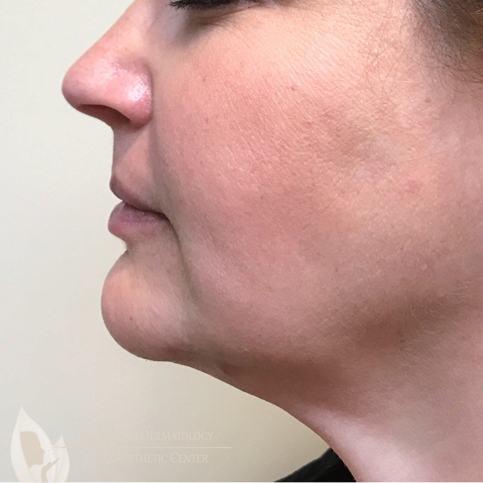 AccuTite After Image at Dr. Desjarlais' Office in Adrian, MI