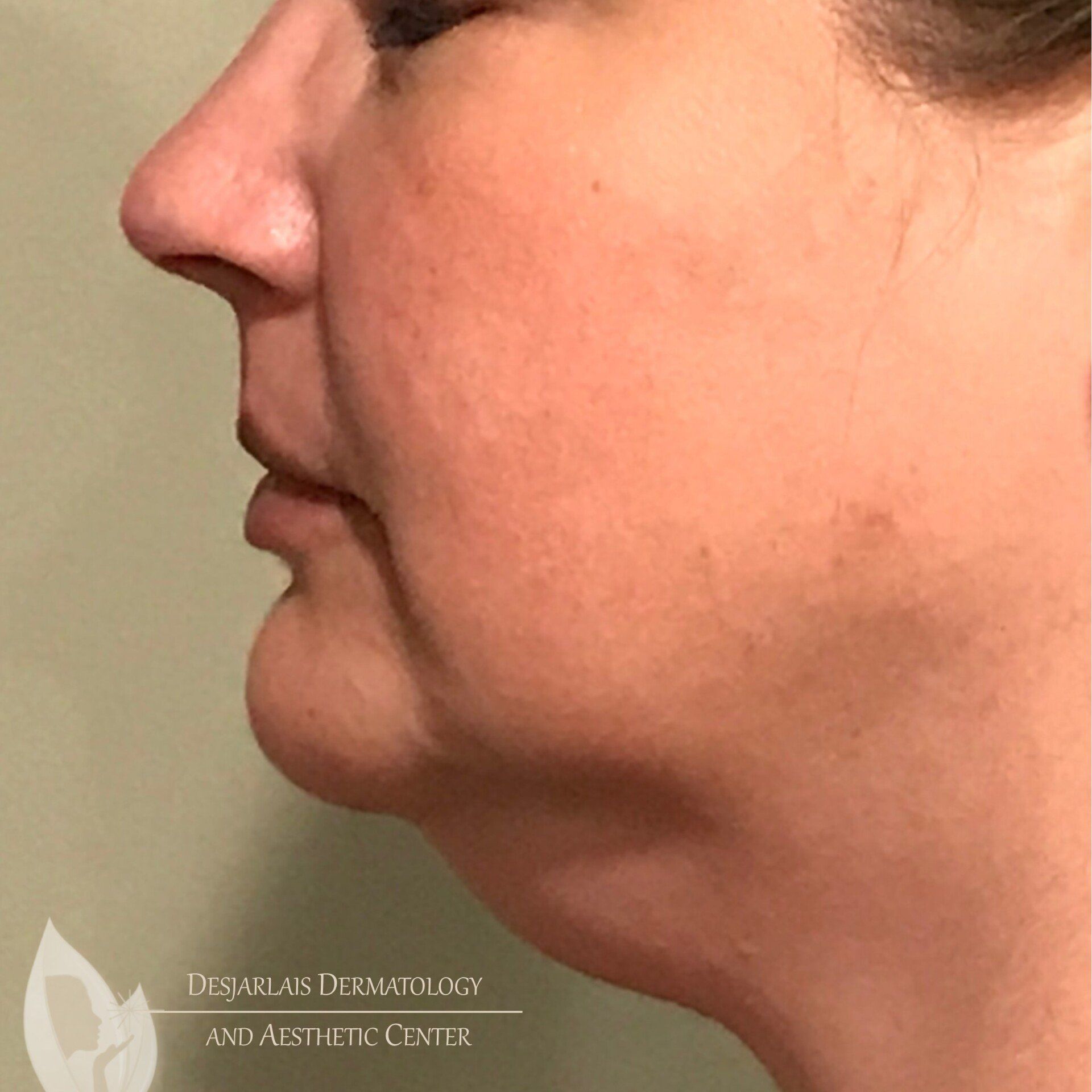 AccuTite Before Image at Dr. Desjarlais' Office in Adrian, MI