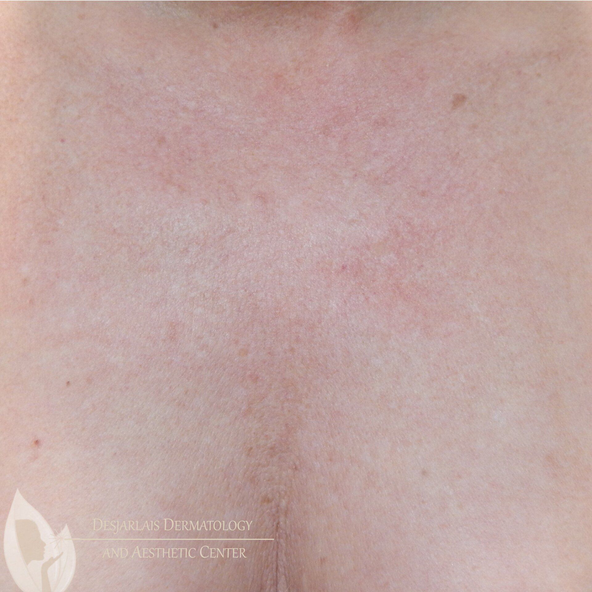 BBL After Image at Dr. Desjarlais' Office in Adrian, MI