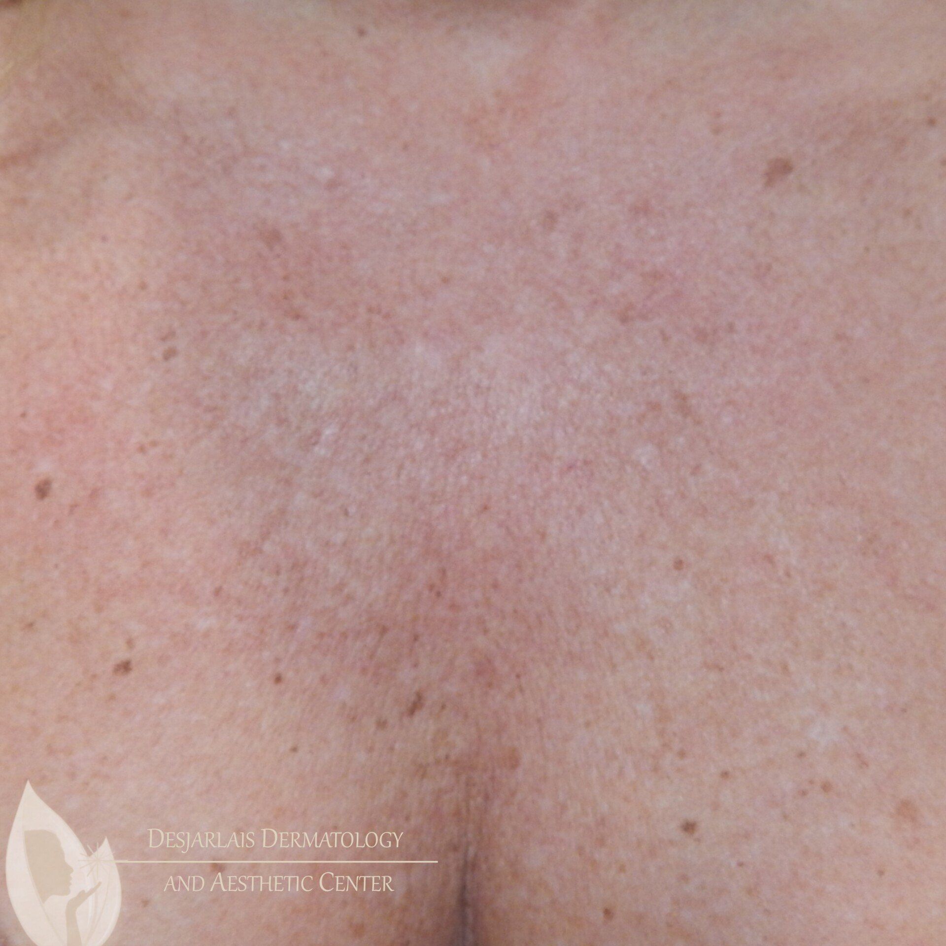 BBL Before Image at Dr. Desjarlais' Office in Adrian, MI