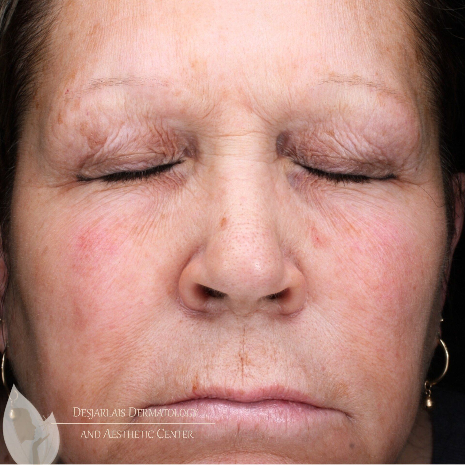 BBL After Image at Dr. Desjarlais' Office in Adrian, MI