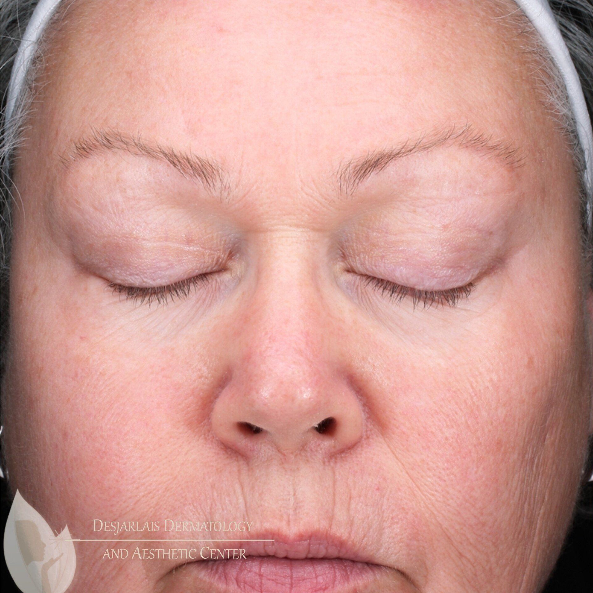 BBL After Image at Dr. Desjarlais' Office in Adrian, MI