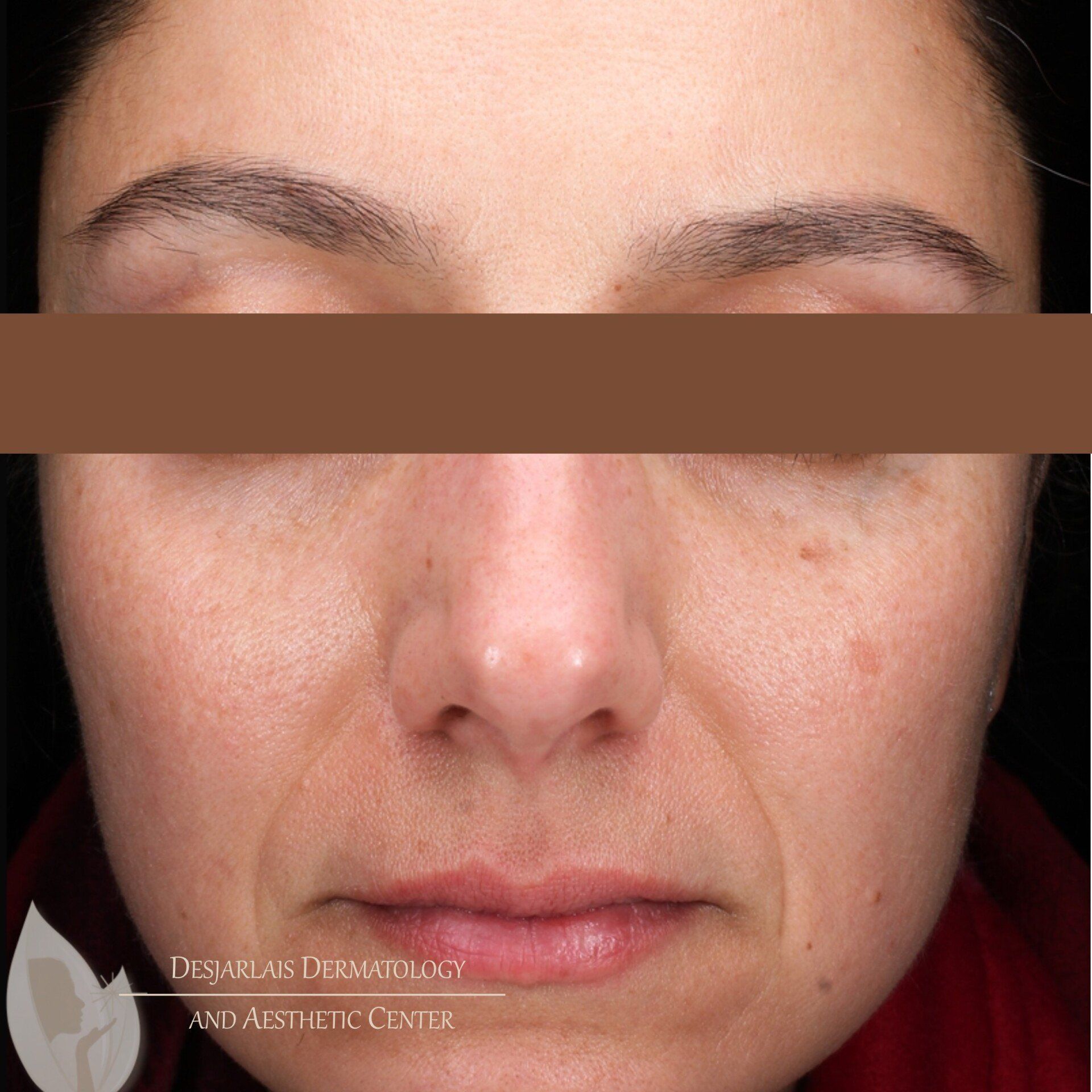 BBL Ultra After Image at Dr. Desjarlais' Office in Adrian, MI