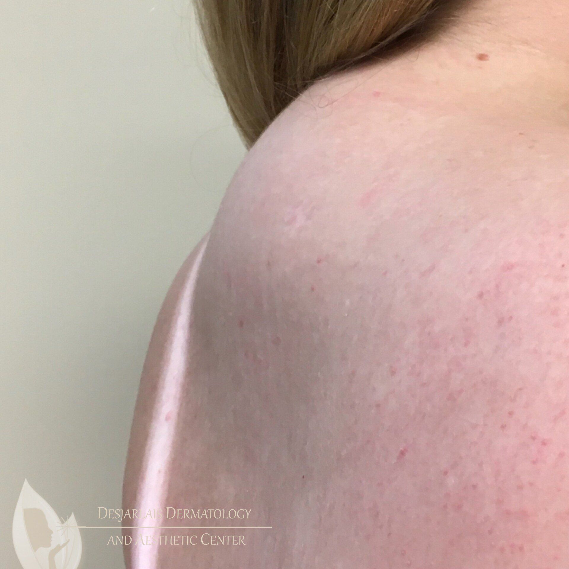 BodyTite Before Image at Dr. Desjarlais' Office in Adrian, MI