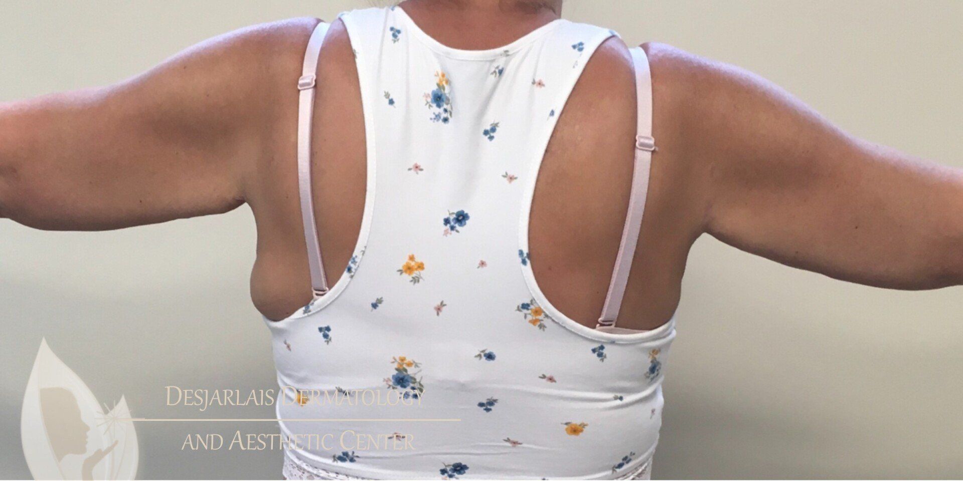 BodyTite Before Image at Dr. Desjarlais' Office in Adrian, MI