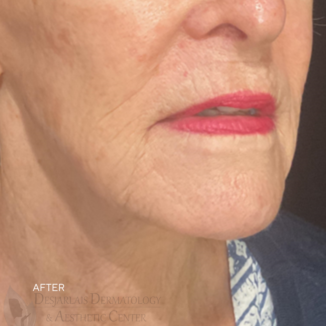 ellacor micro-coring After Image at Dr. Desjarlais' Office in Adrian, MI