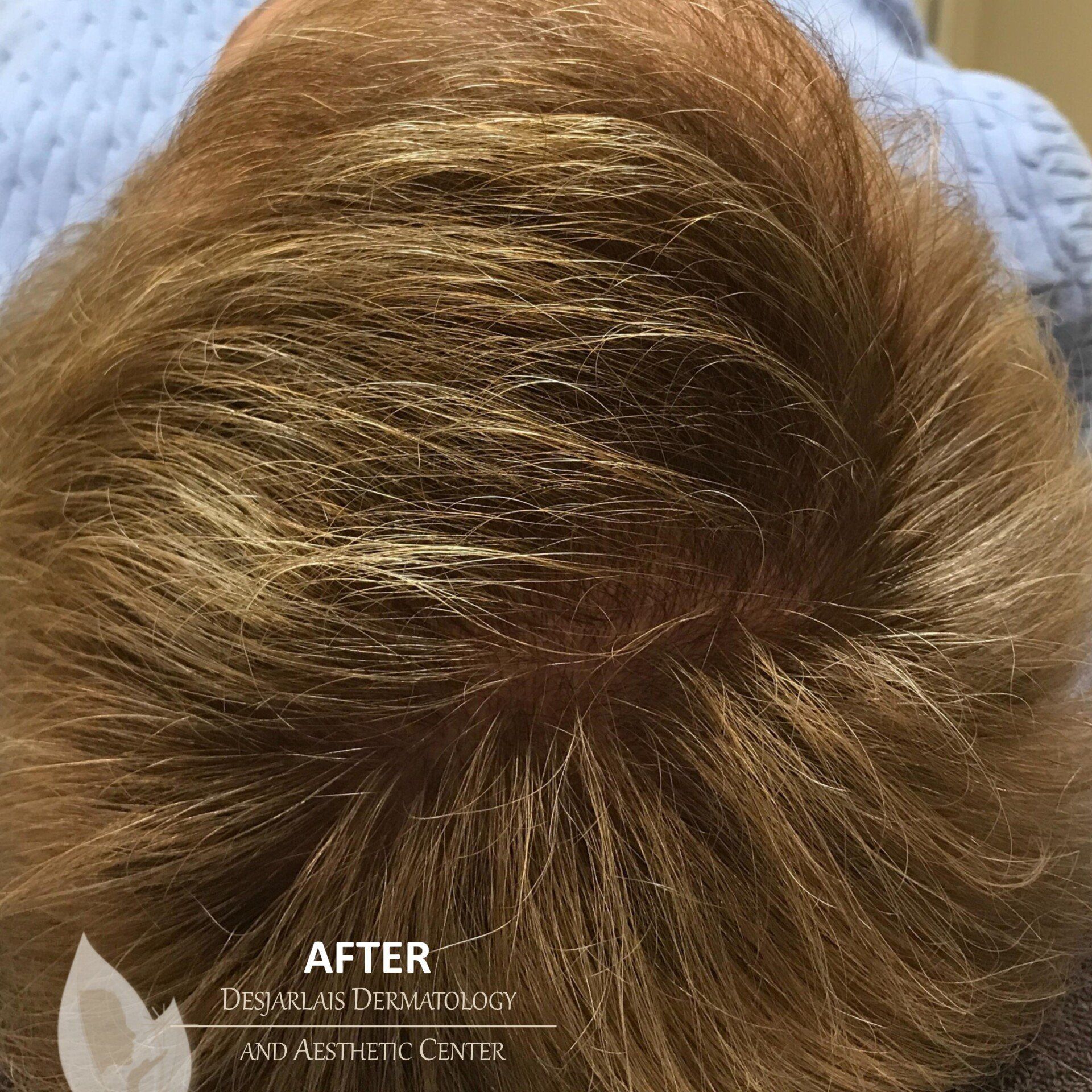 Keralase Hair Restoration After Image at Dr. Desjarlais' Office in Adrian, MI