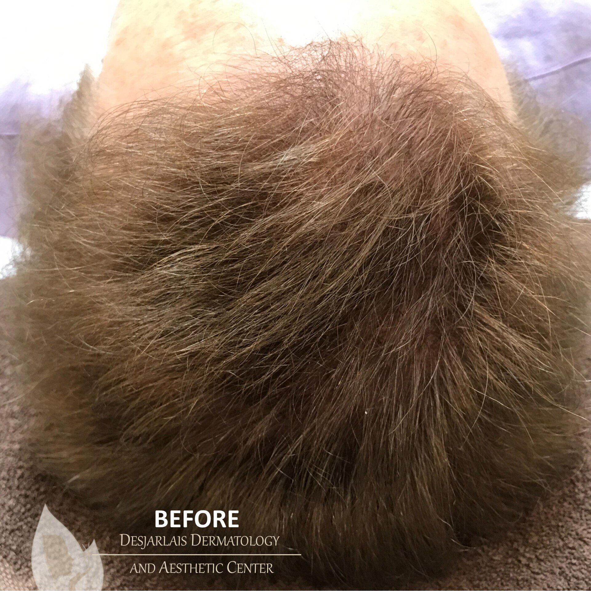 Keralase Hair Restoration Before Image at Dr. Desjarlais' Office in Adrian, MI