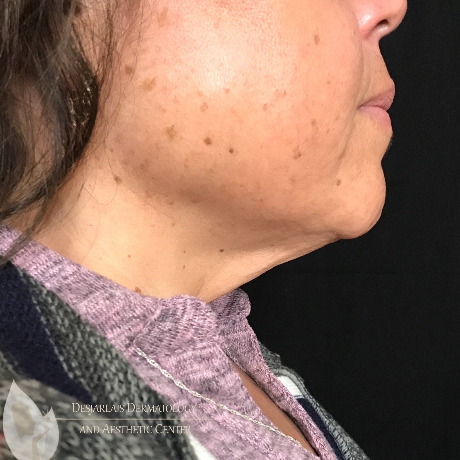 AccuTite After Image at Dr. Desjarlais' Office in Adrian, MI