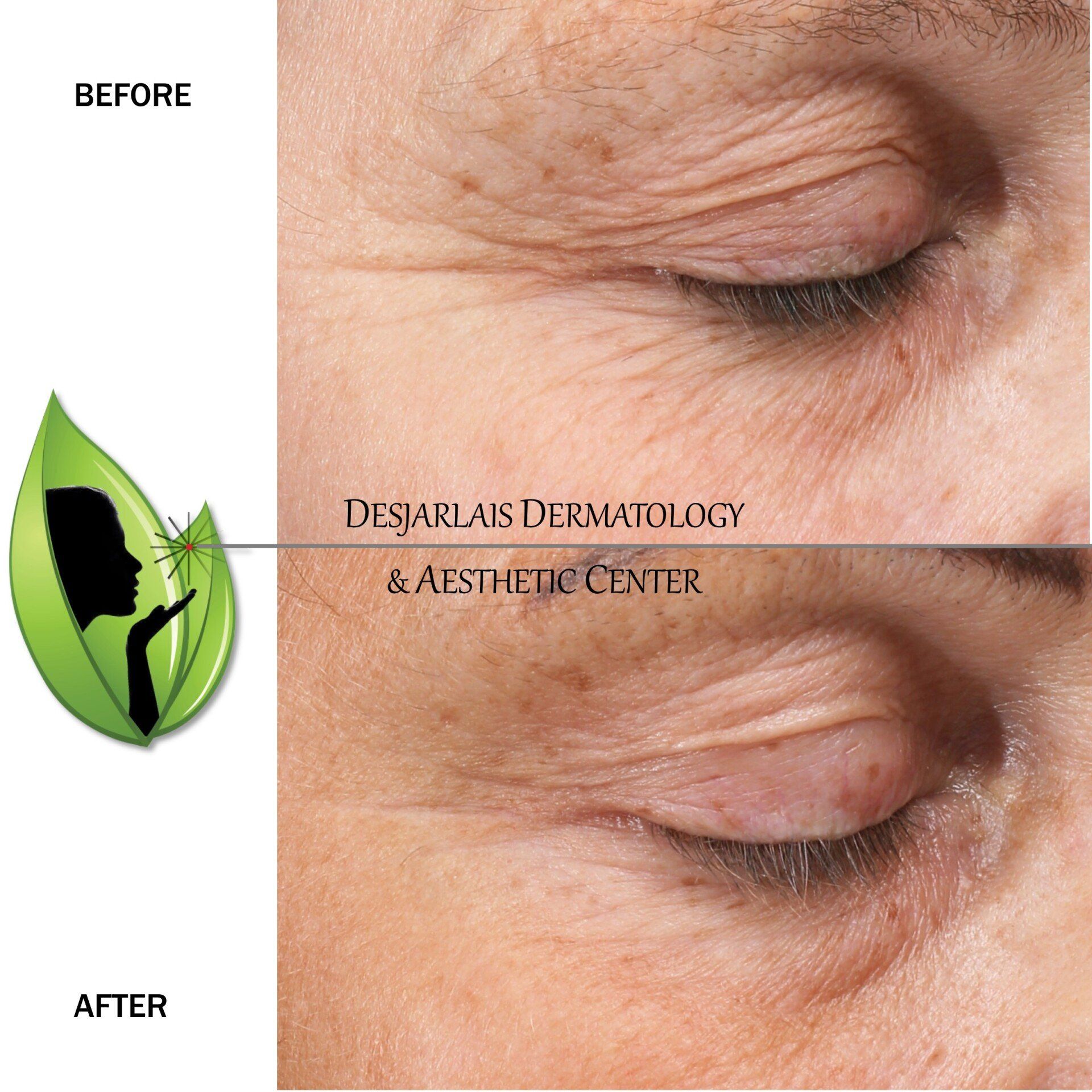 BBL Ultra Before and After Images