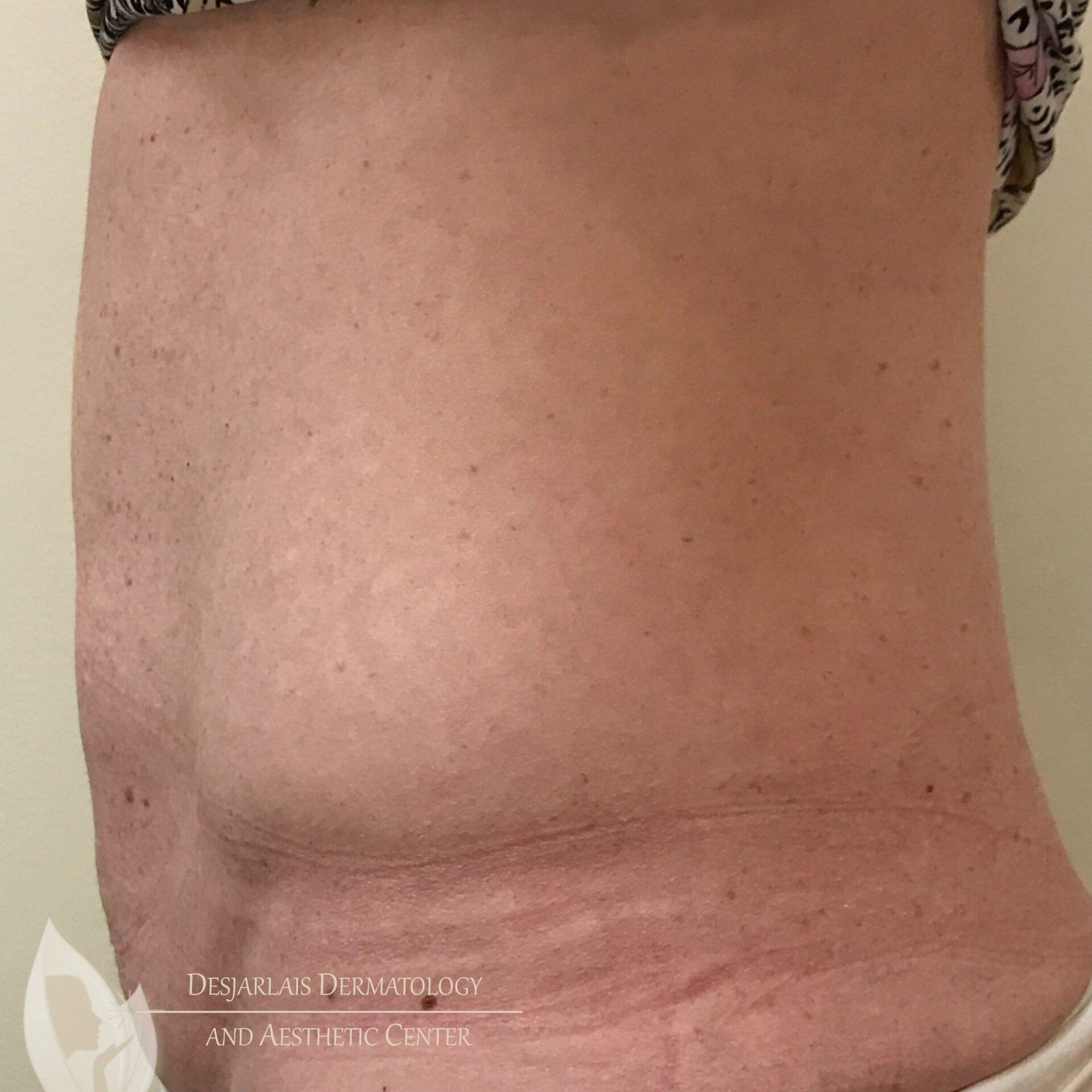 Evolve Procedure After Image at Dr. Desjarlais' Office in Adrian, MI