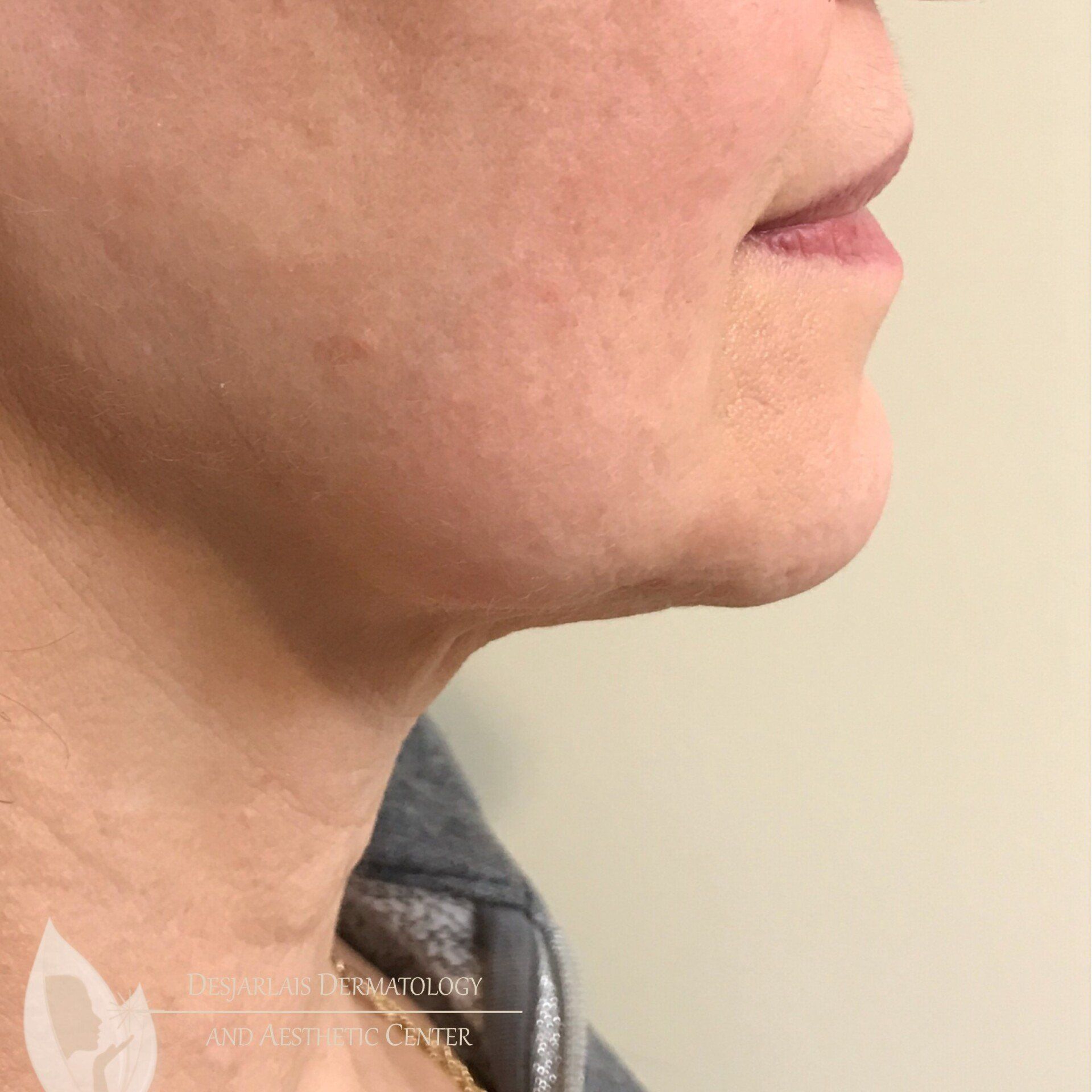 IntraGen After Image at Dr. Desjarlais' Office in Adrian, MI