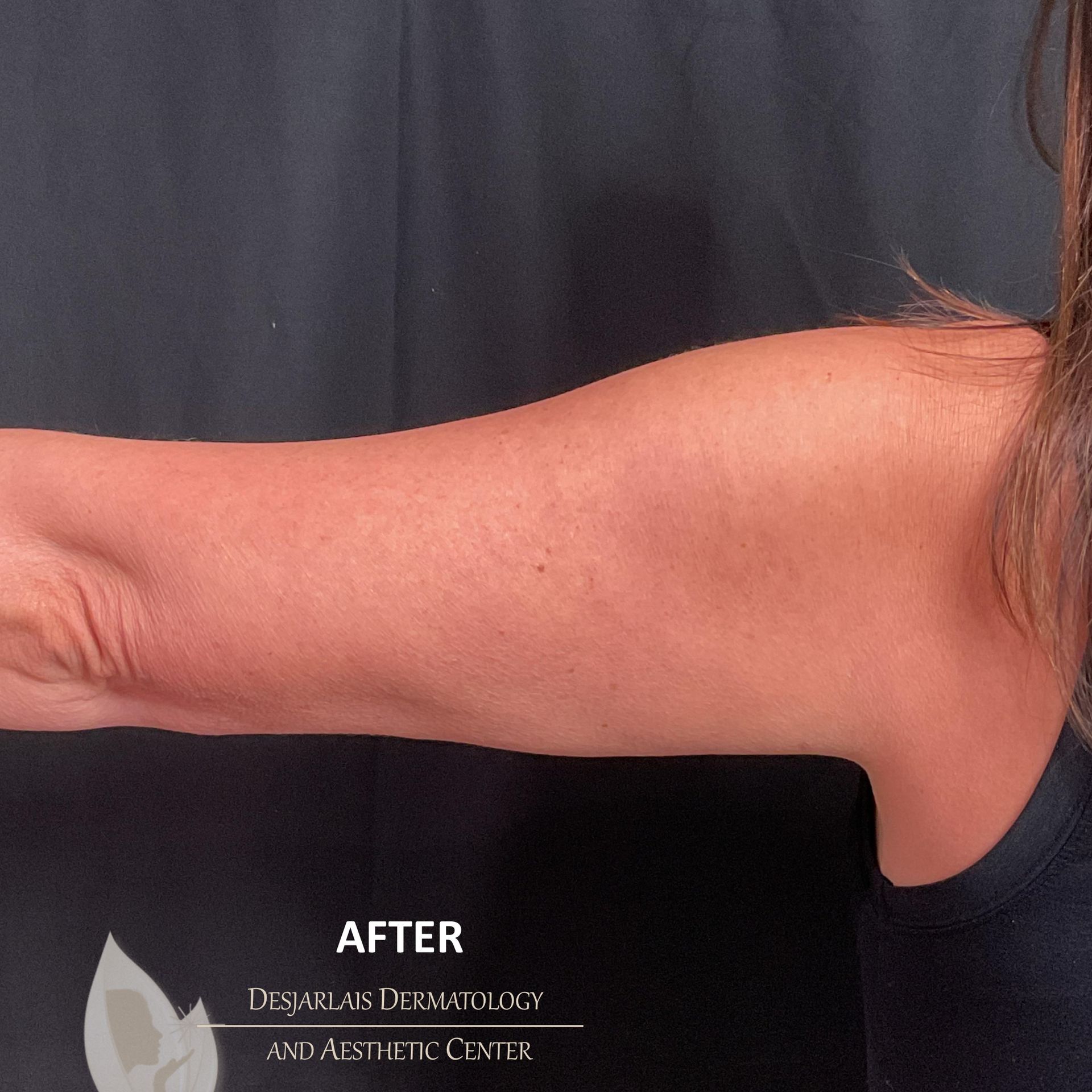 BodyTite After Image at Dr. Desjarlais' Office in Adrian, MI