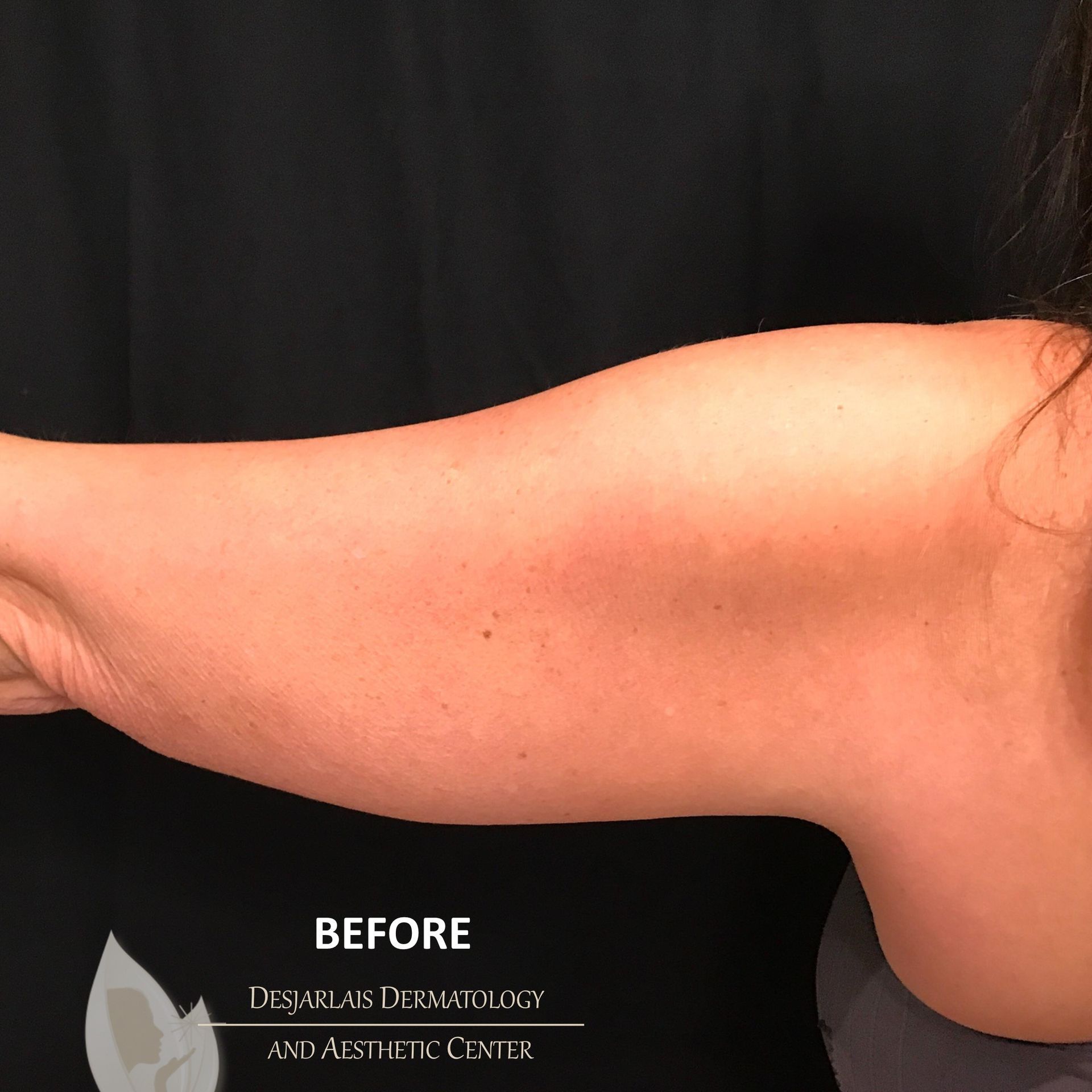 BodyTite Before Image at Dr. Desjarlais' Office in Adrian, MI