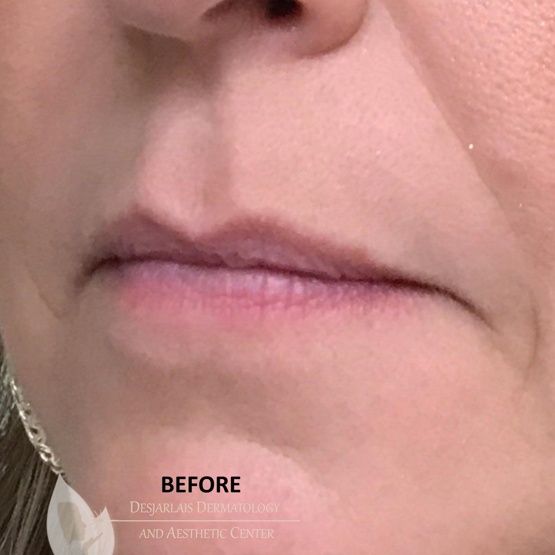 Lip Filler Before Image at Dr. Desjarlais' Office in Adrian, MI