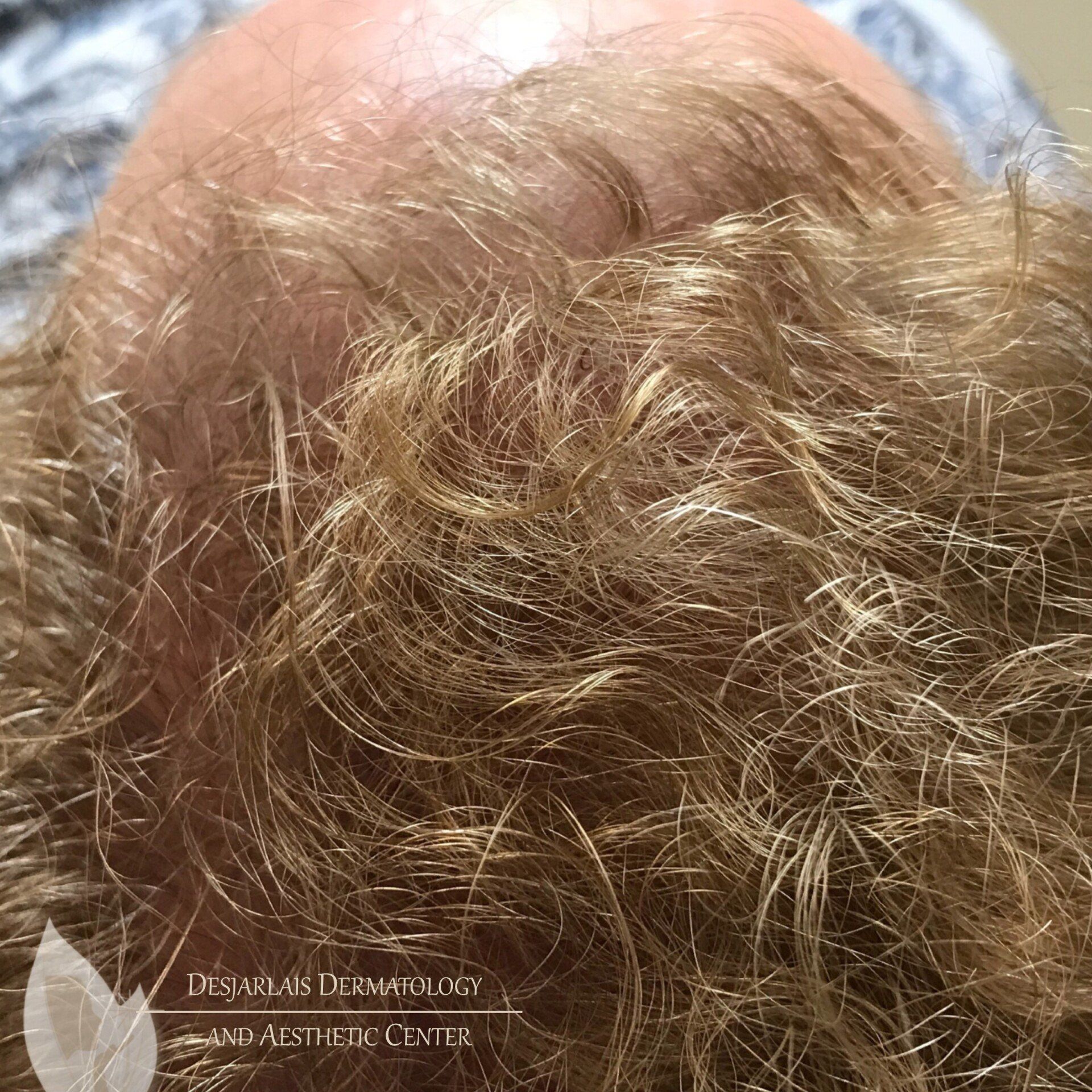 Keralase Hair Restoration After Image at Dr. Desjarlais' Office in Adrian, MI