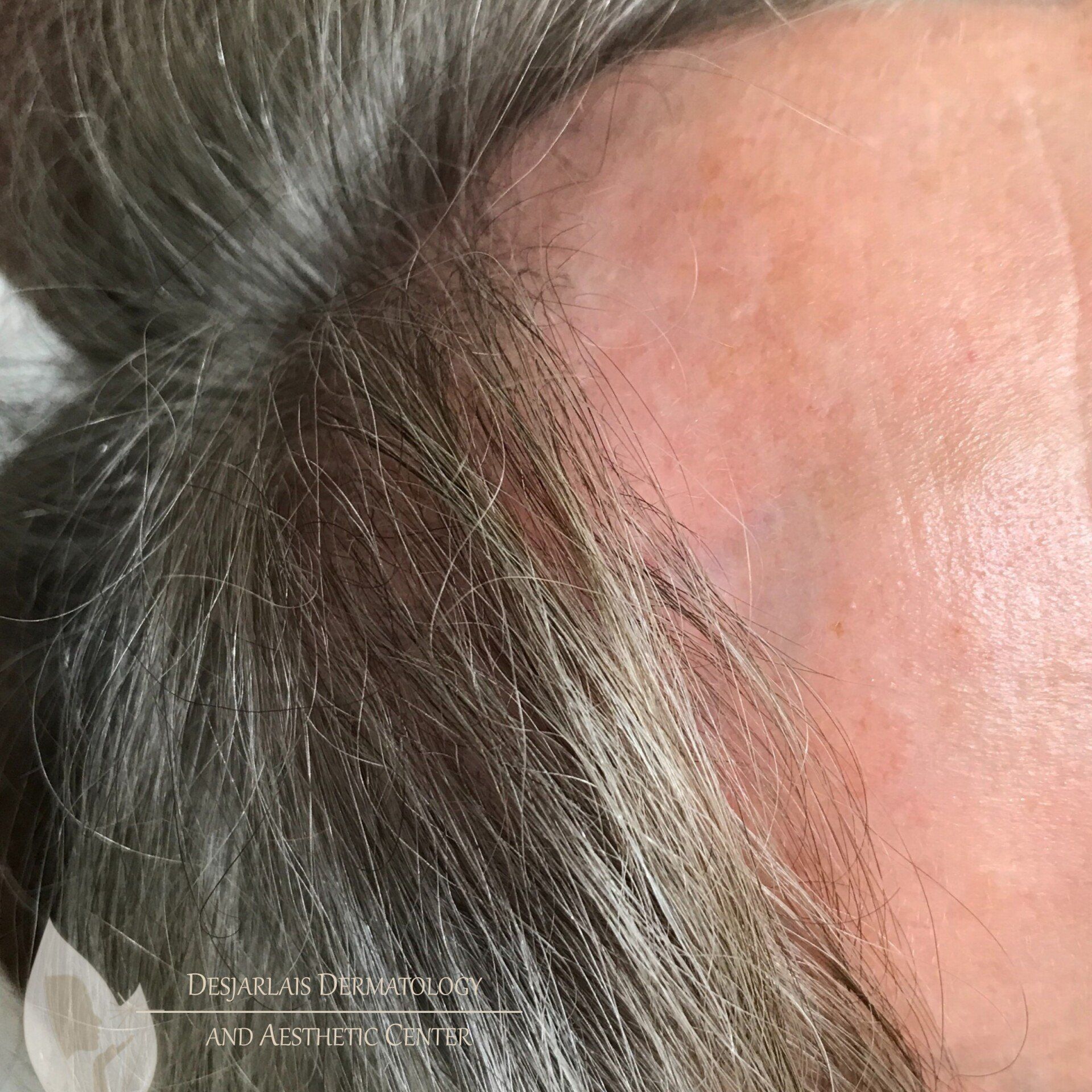 Keralase Hair Restoration After Image at Dr. Desjarlais' Office in Adrian, MI