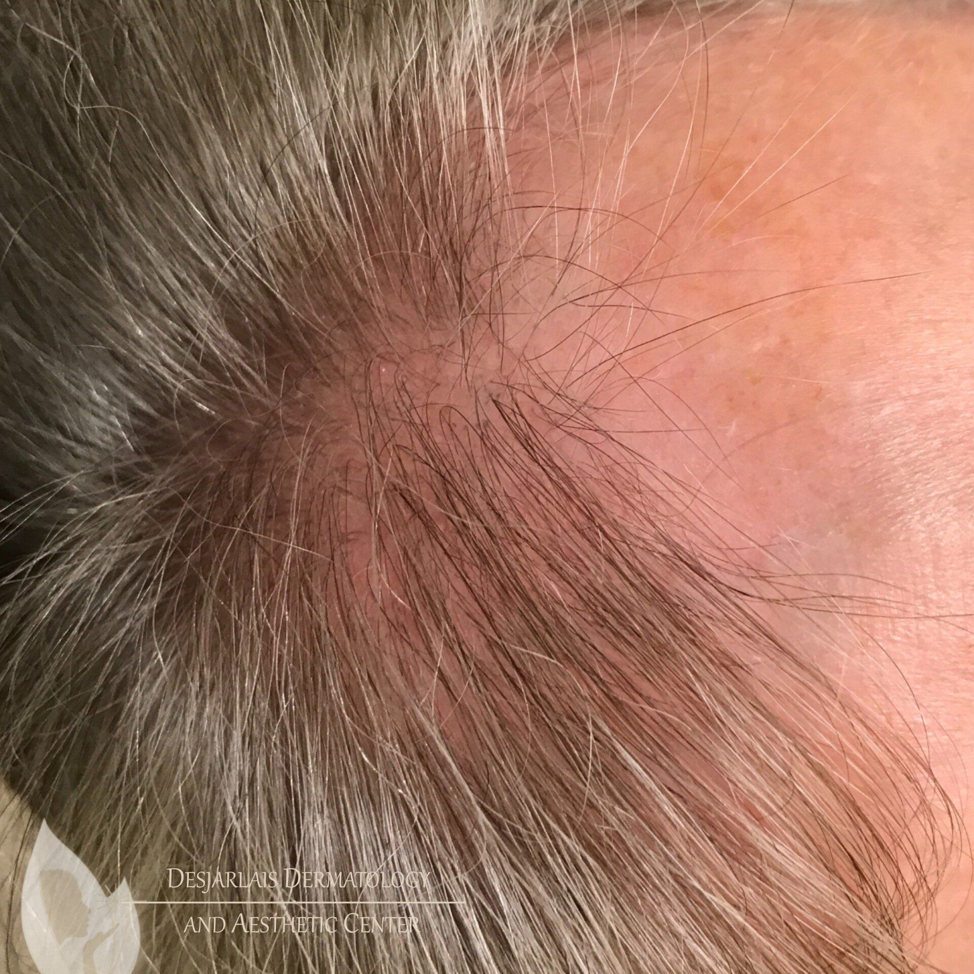 Keralase Hair Restoration Before Image at Dr. Desjarlais' Office in Adrian, MI