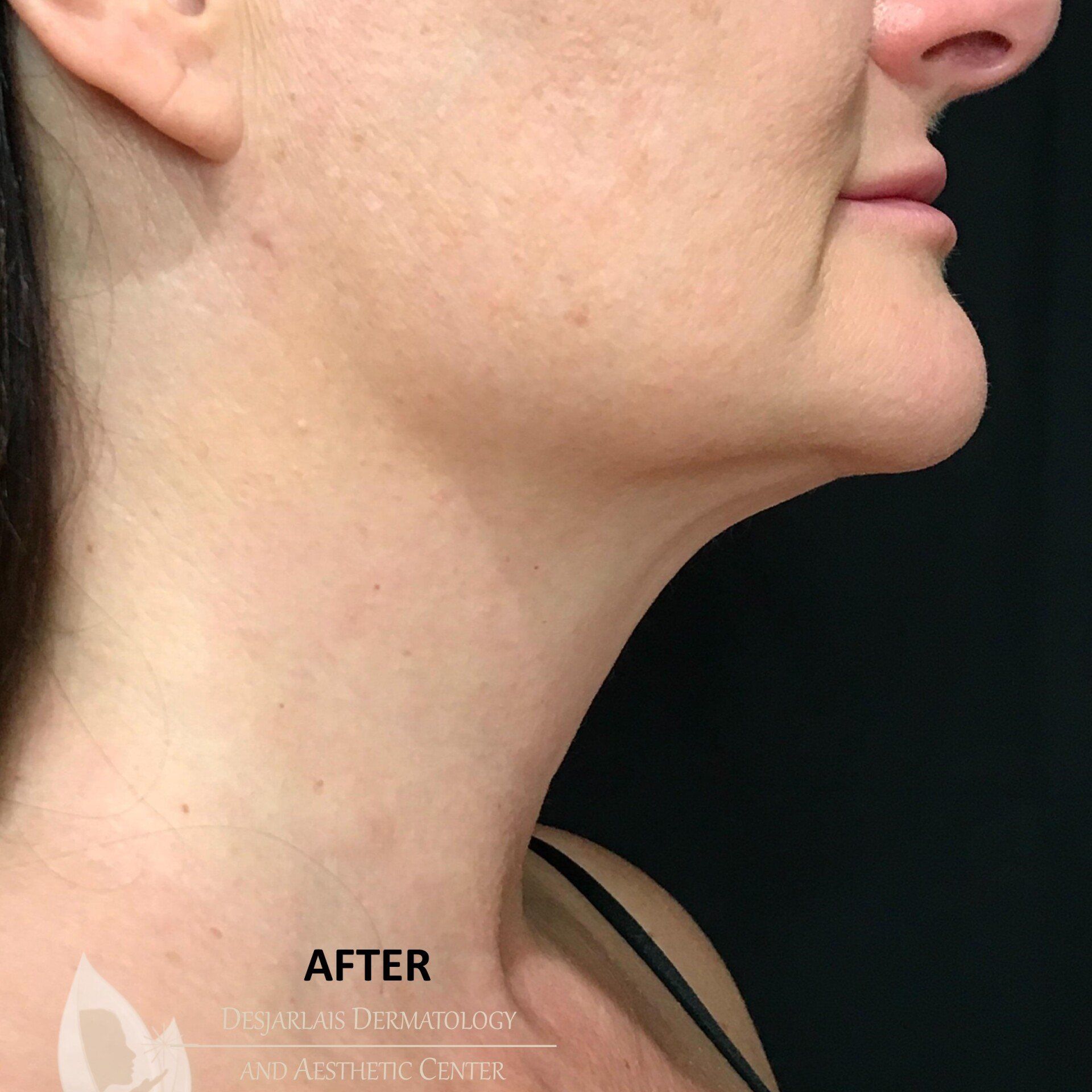 AccuTite After Image at Dr. Desjarlais' Office in Adrian, MI