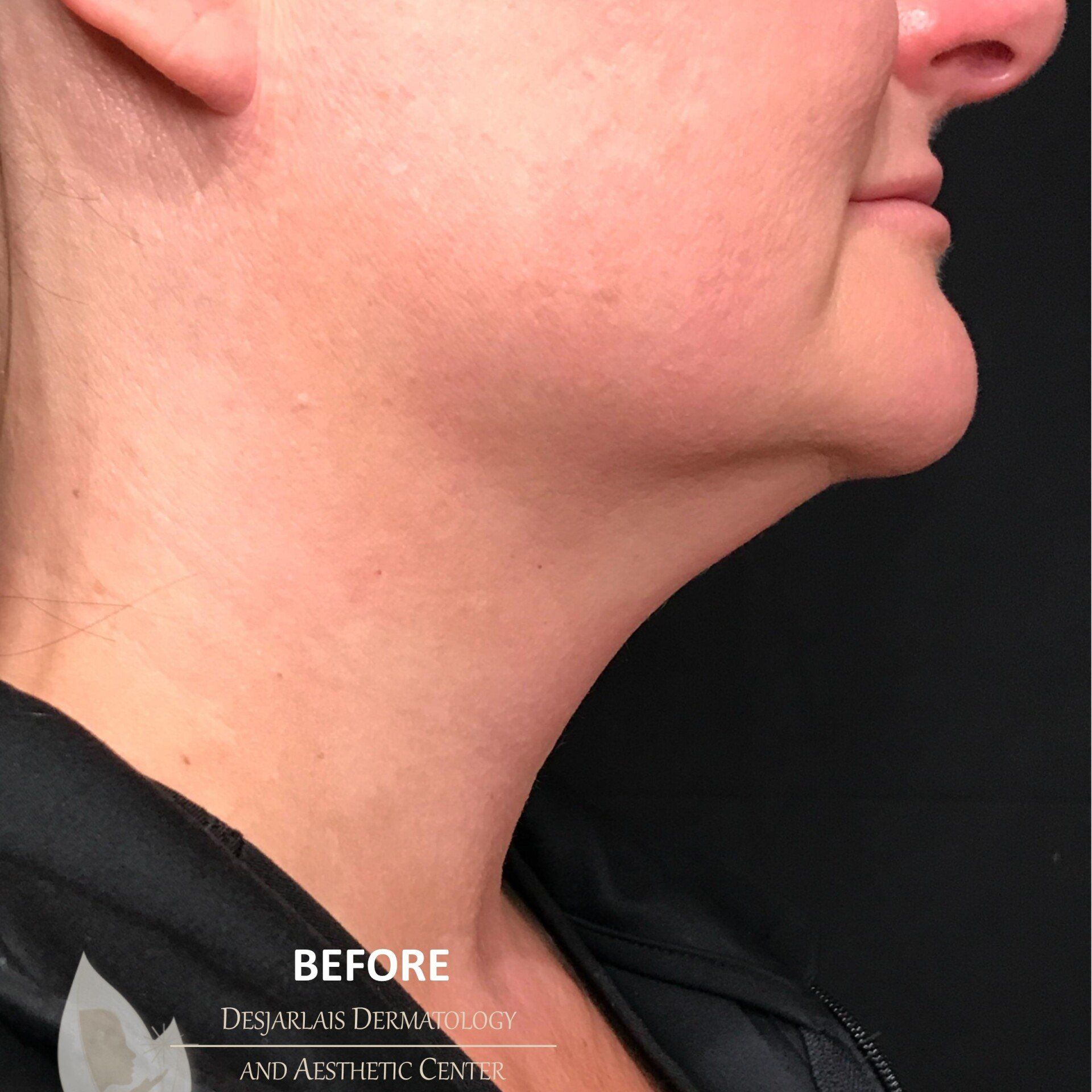AccuTite Before Image at Dr. Desjarlais' Office in Adrian, MI
