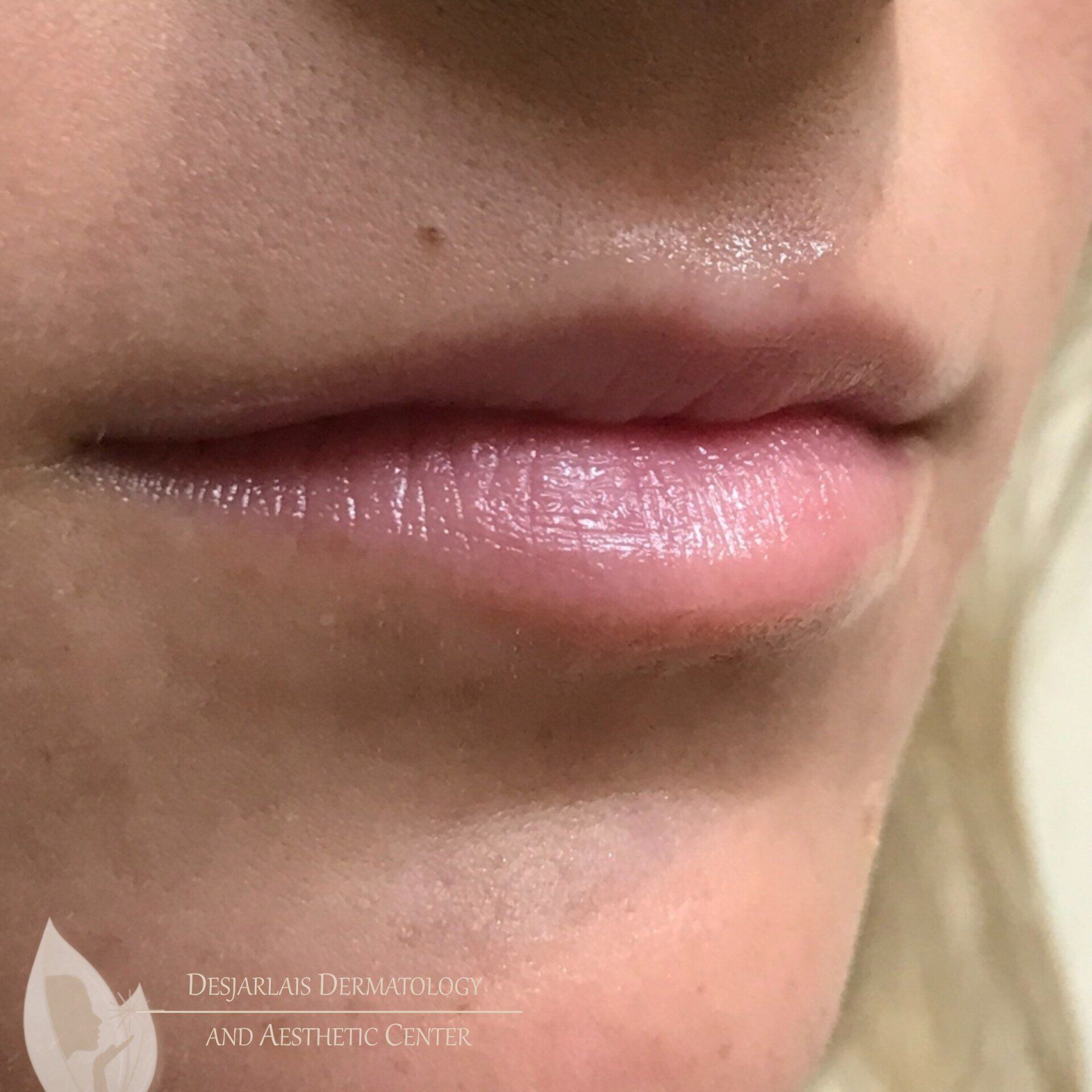 Lip Filler Before Image at Dr. Desjarlais' Office in Adrian, MI