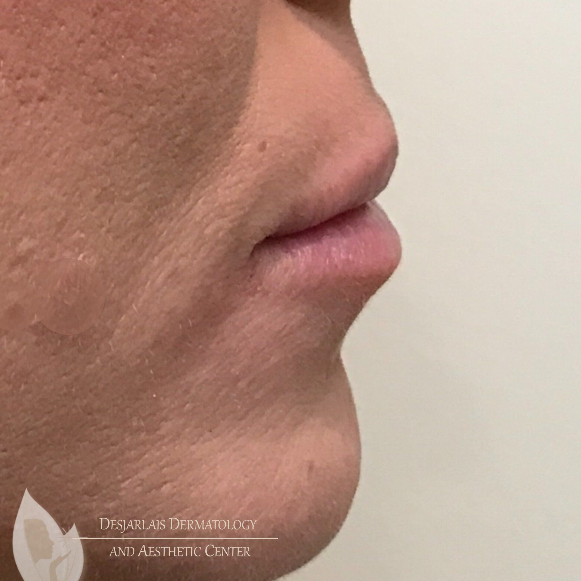 Lip Filler After Image at Dr. Desjarlais' Office in Adrian, MI