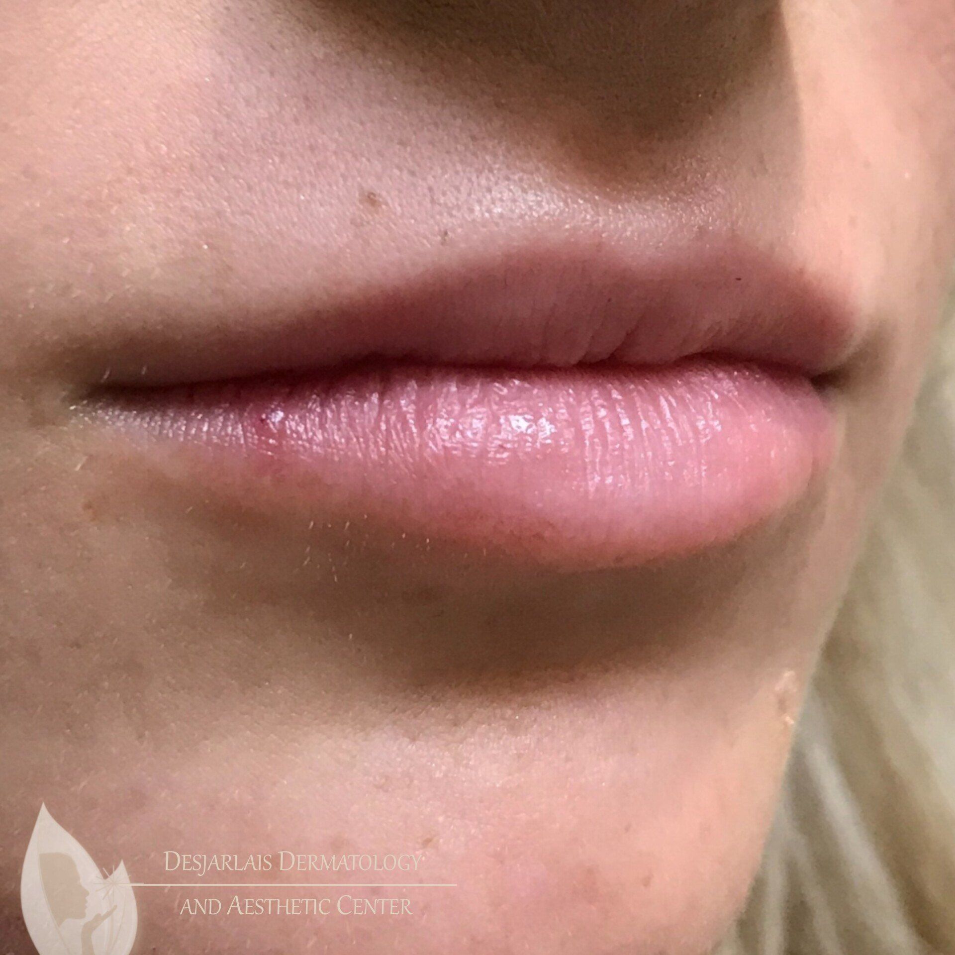 Lip Filler After Image at Dr. Desjarlais' Office in Adrian, MI