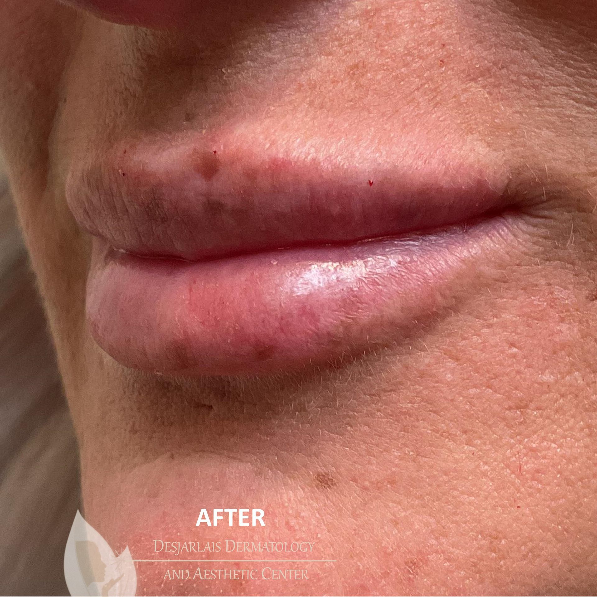 Lip Filler After Image at Dr. Desjarlais' Office in Adrian, MI