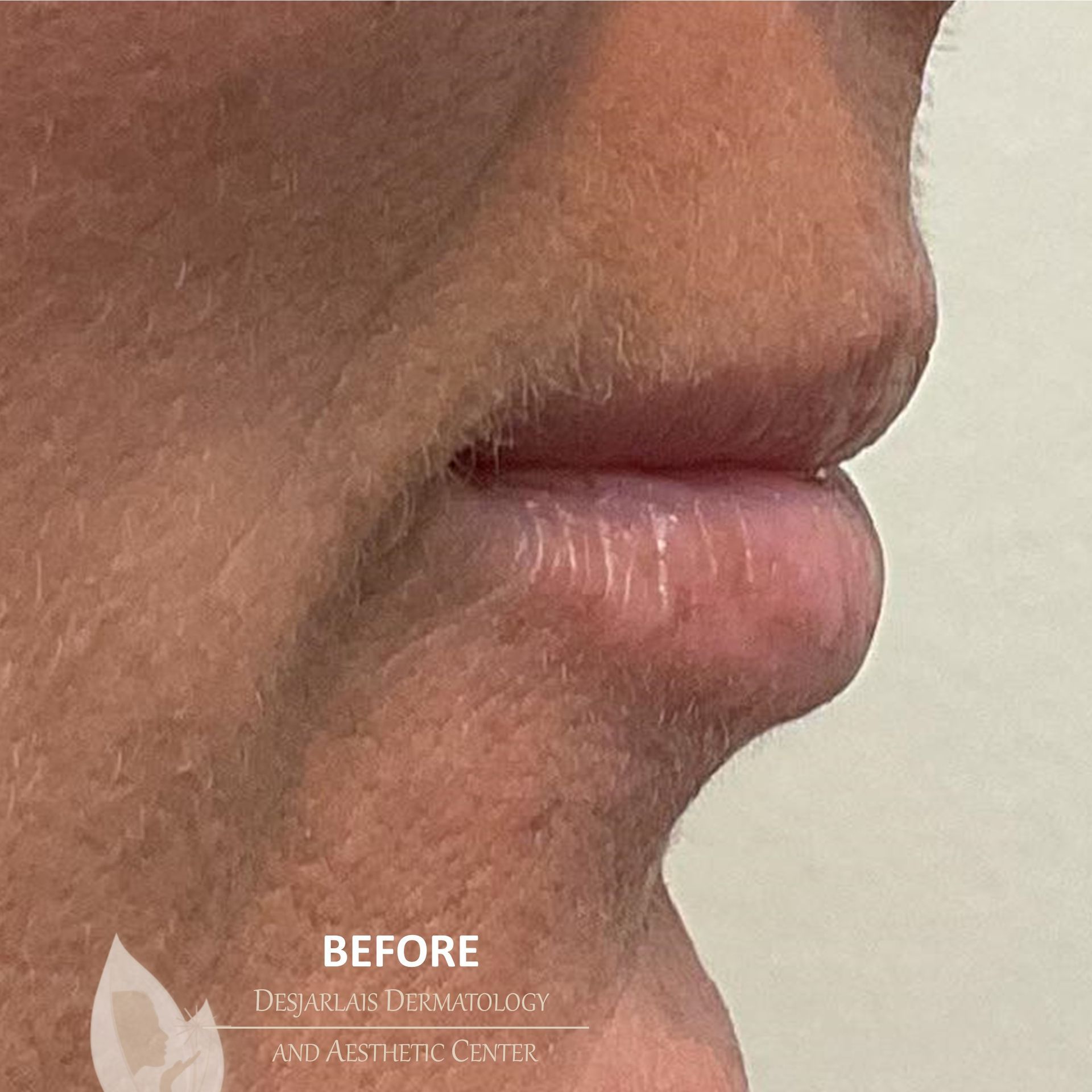 Lip Filler Before Image at Dr. Desjarlais' Office in Adrian, MI