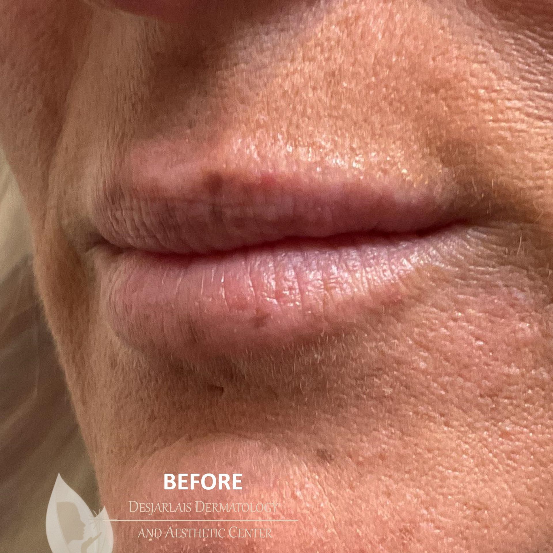 Lip Filler Before Image at Dr. Desjarlais' Office in Adrian, MI