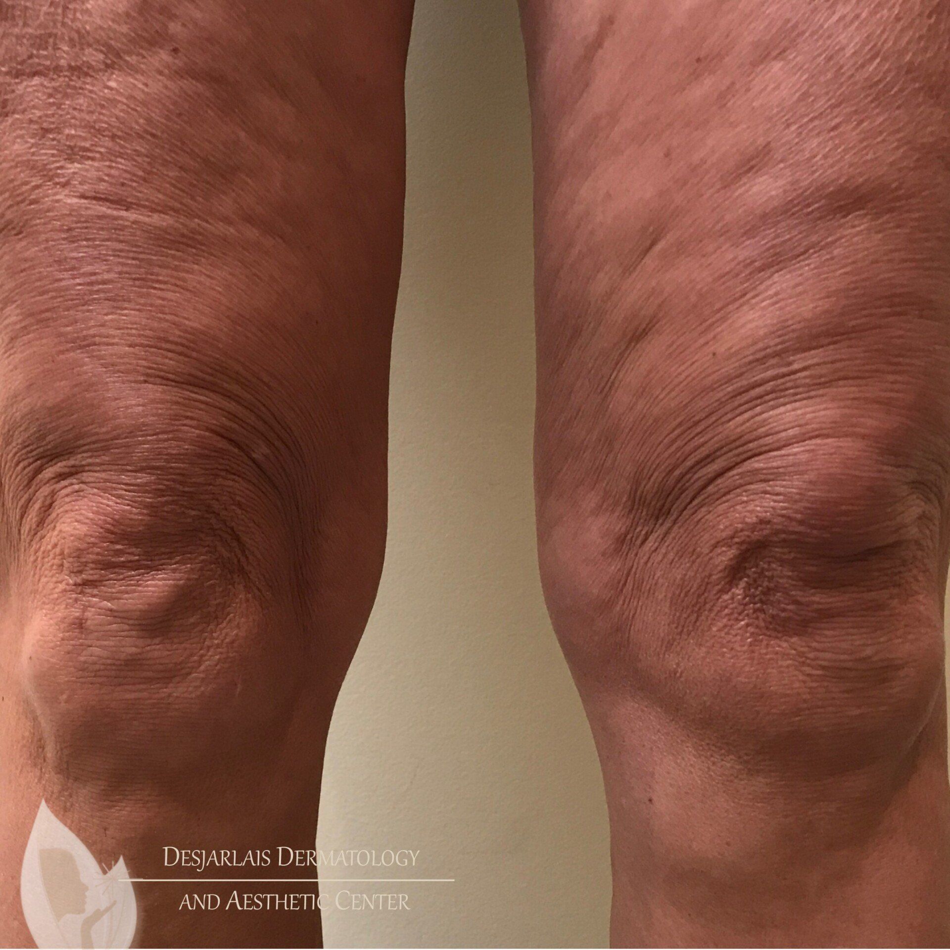 Morpheus 8 Before Image at Dr. Desjarlais' Office in Adrian, MI