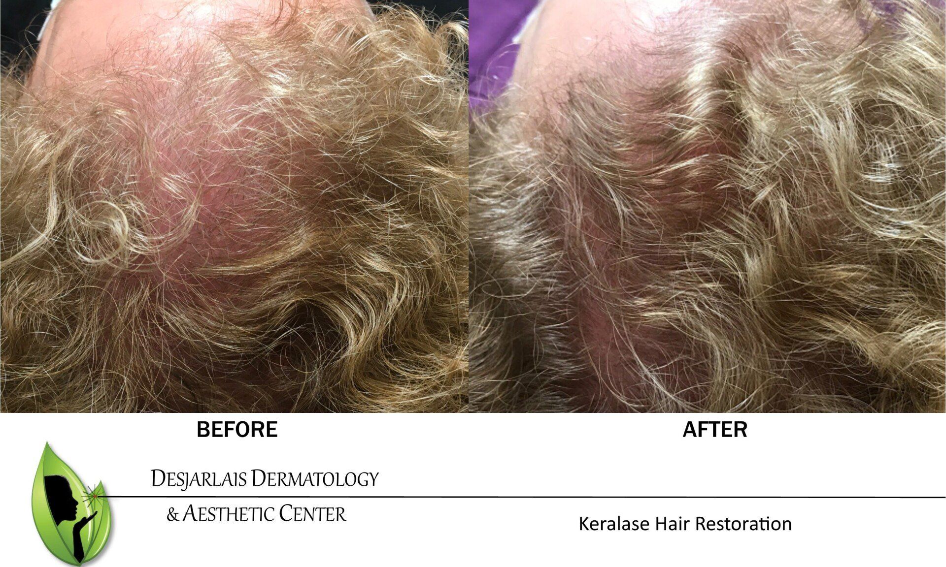 Keralase Hair Restoration Before and After Image