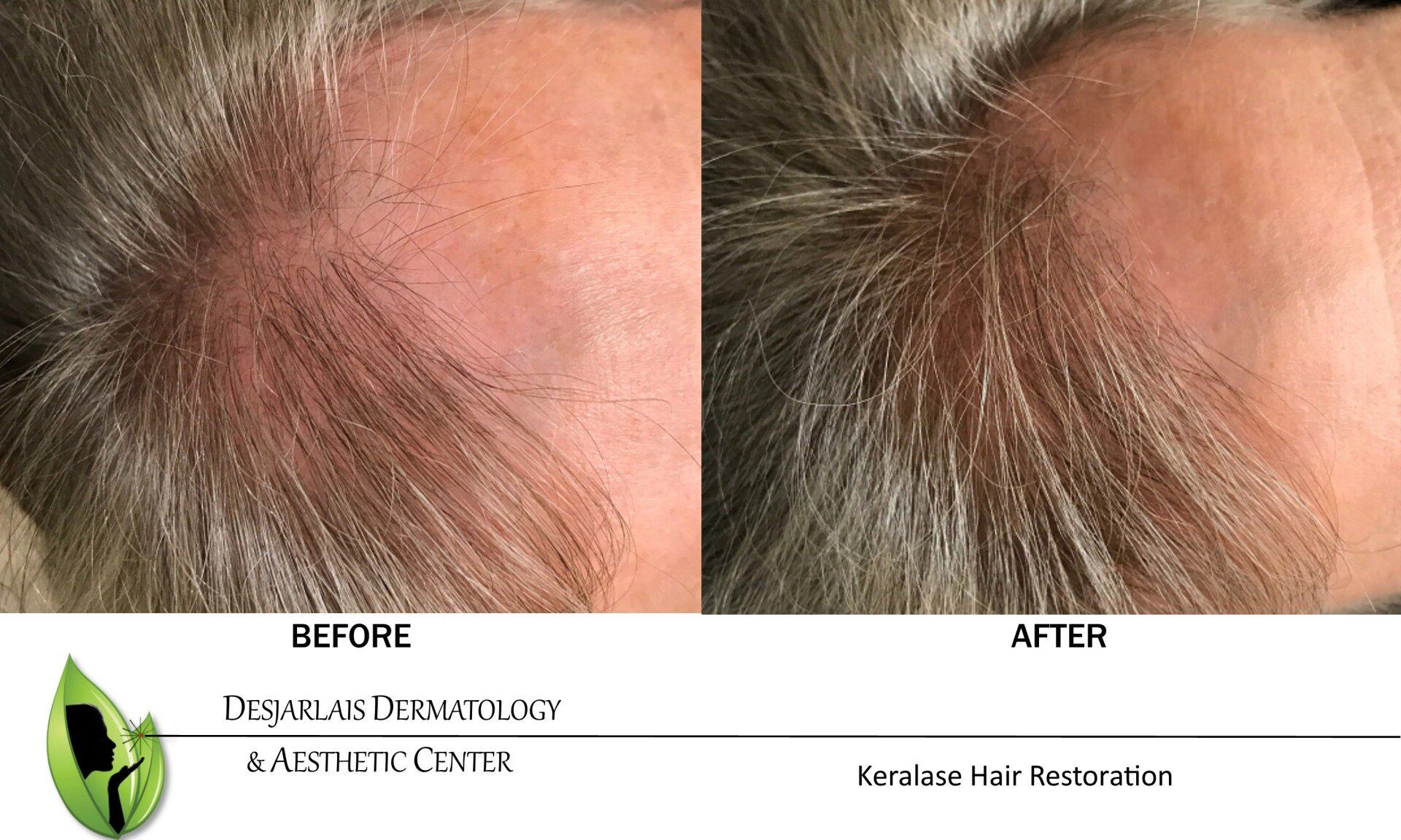A before and after photo of Keralase Hair Restoration