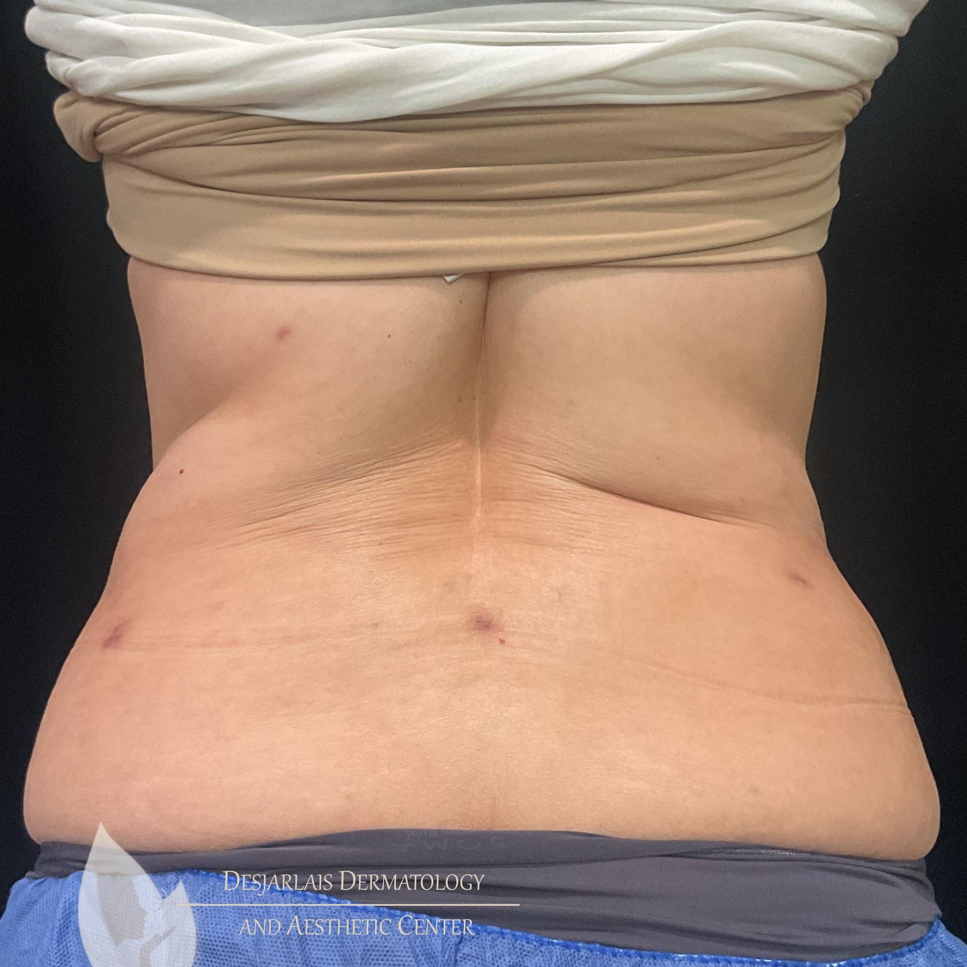 BodyTite After Image at Dr. Desjarlais' Office in Adrian, MI