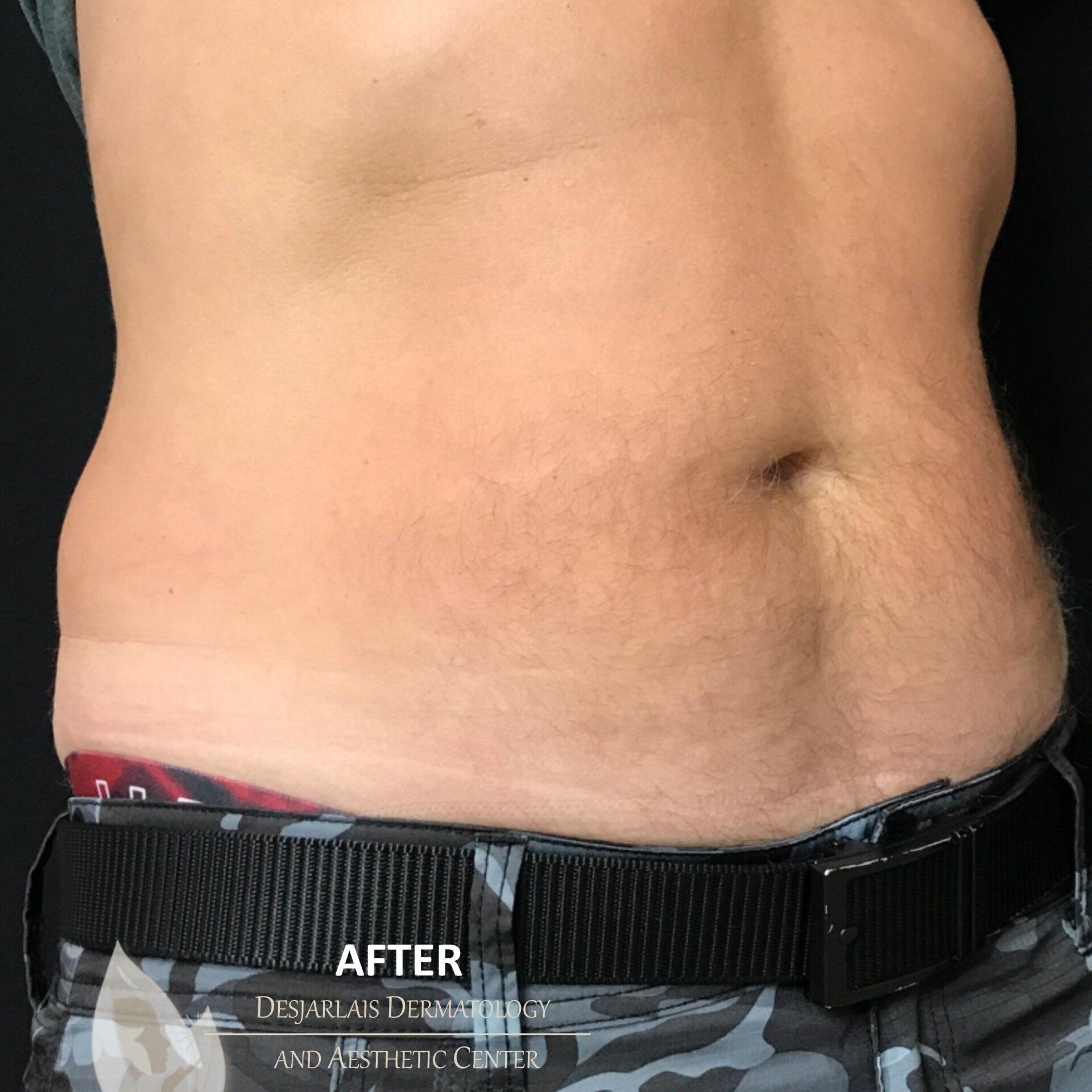 BodyTite After Image at Dr. Desjarlais' Office in Adrian, MI
