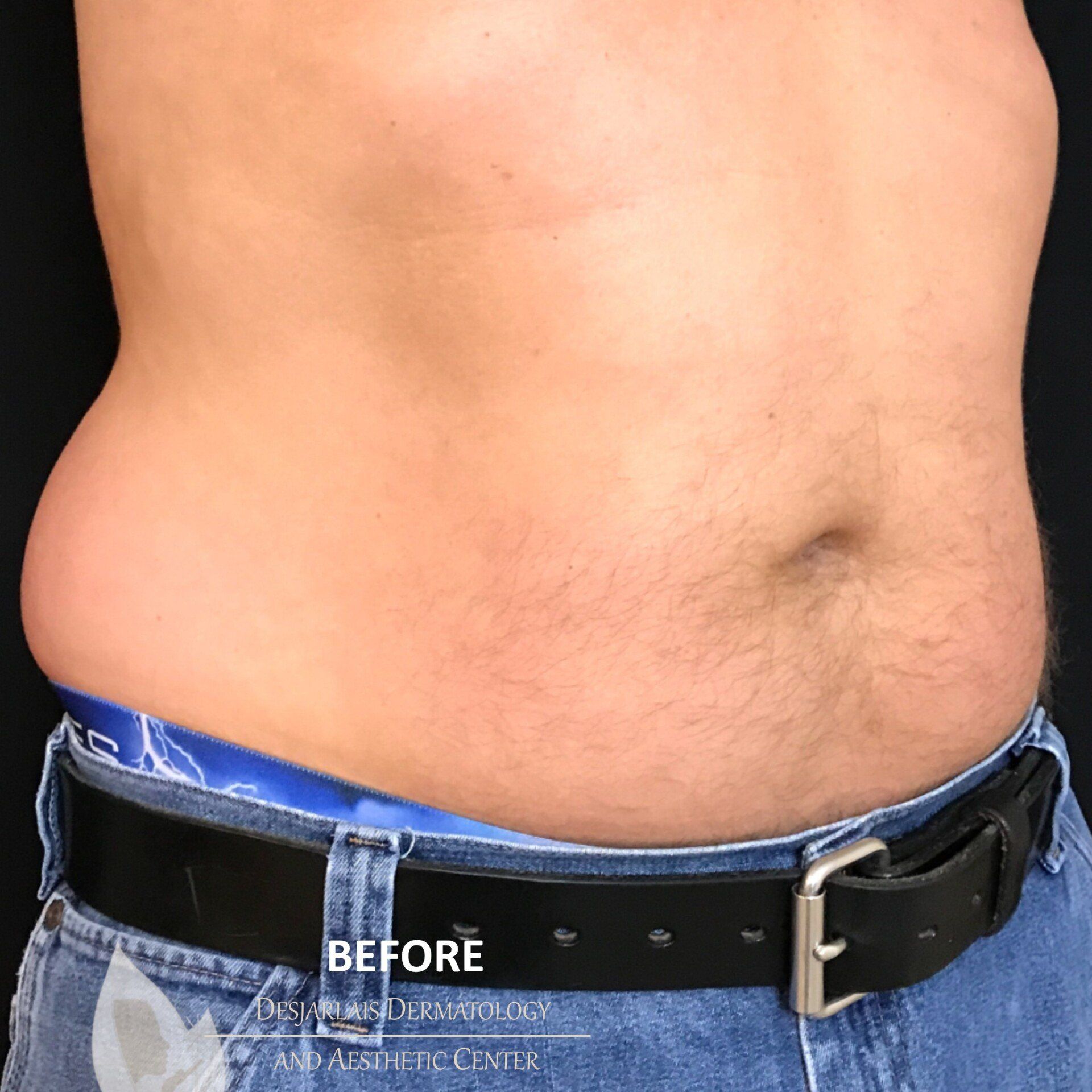 BodyTite Before Image at Dr. Desjarlais' Office in Adrian, MI