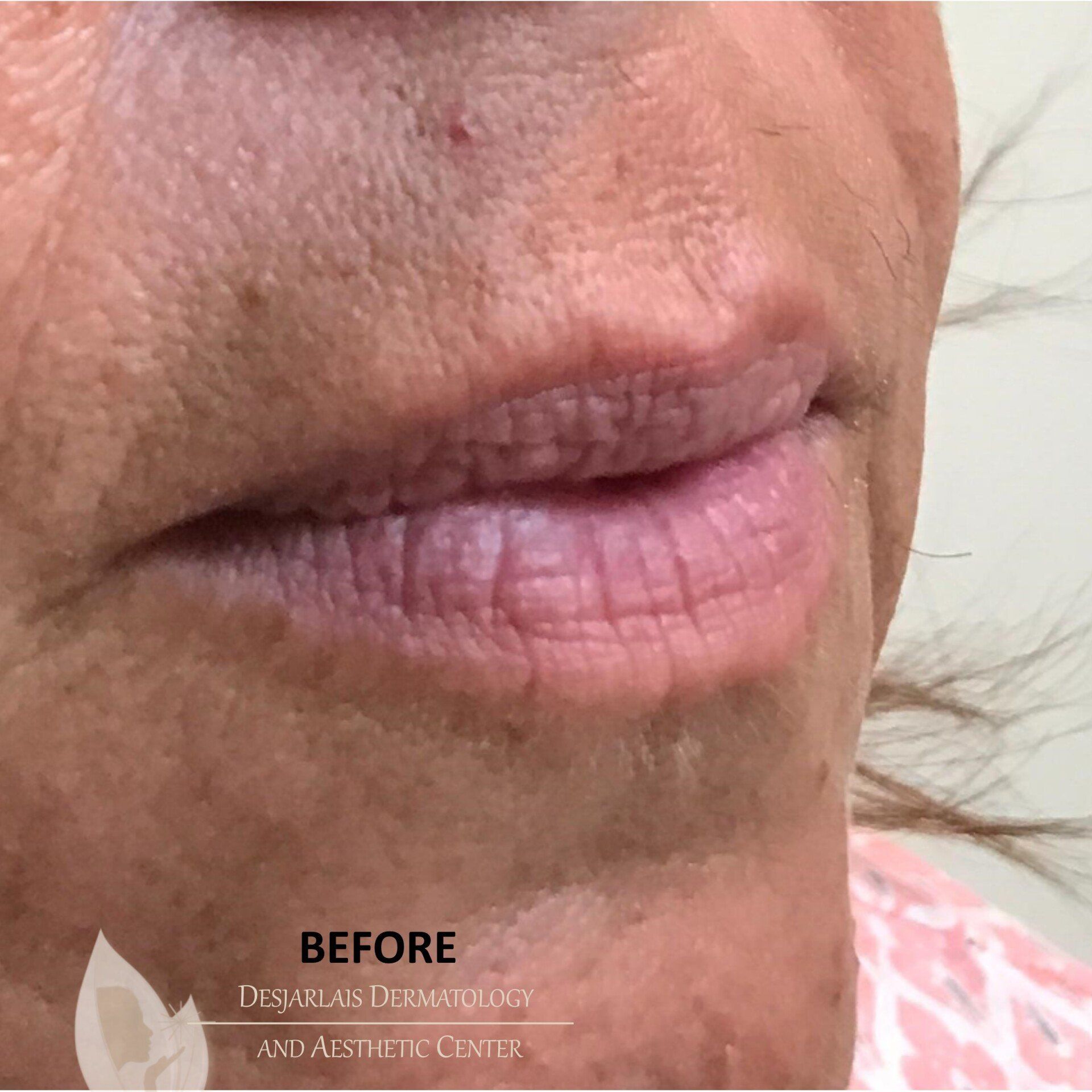 Lip Filler Before Image at Dr. Desjarlais' Office in Adrian, MI