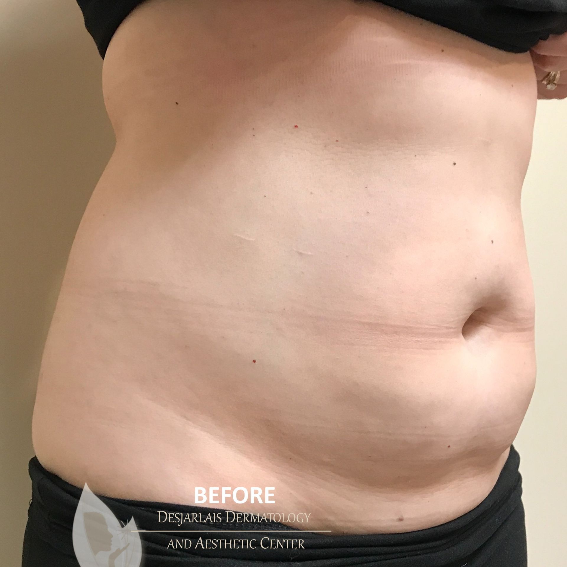 BodyTite Before Image at Dr. Desjarlais' Office in Adrian, MI
