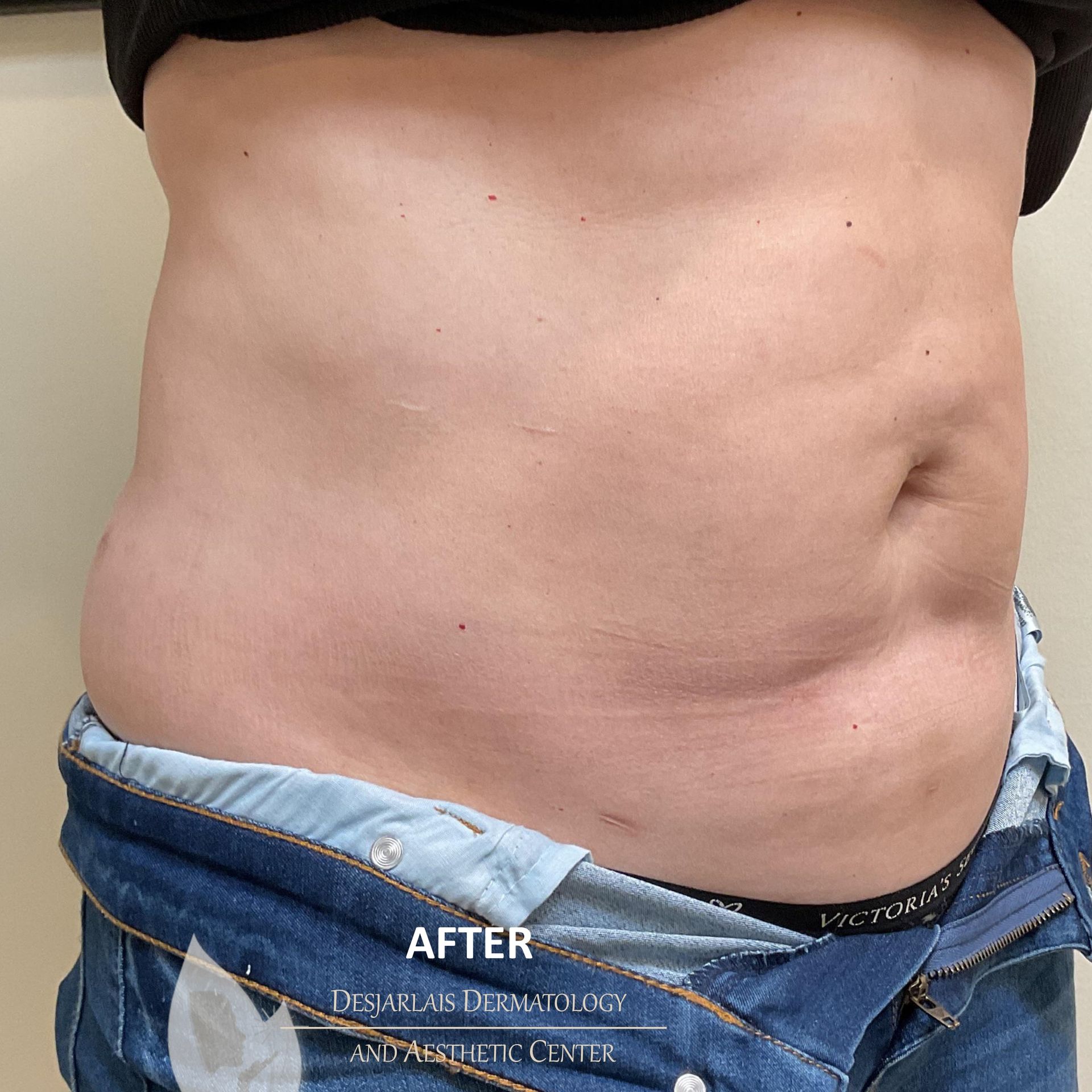 BodyTite After Image at Dr. Desjarlais' Office in Adrian, MI