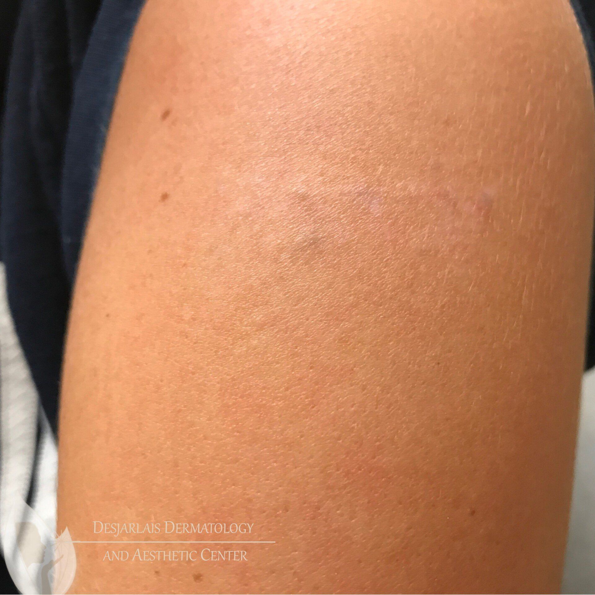 Tattoo Removal on Arm After Image at Dr. Desjarlais' Office in Adrian, MI