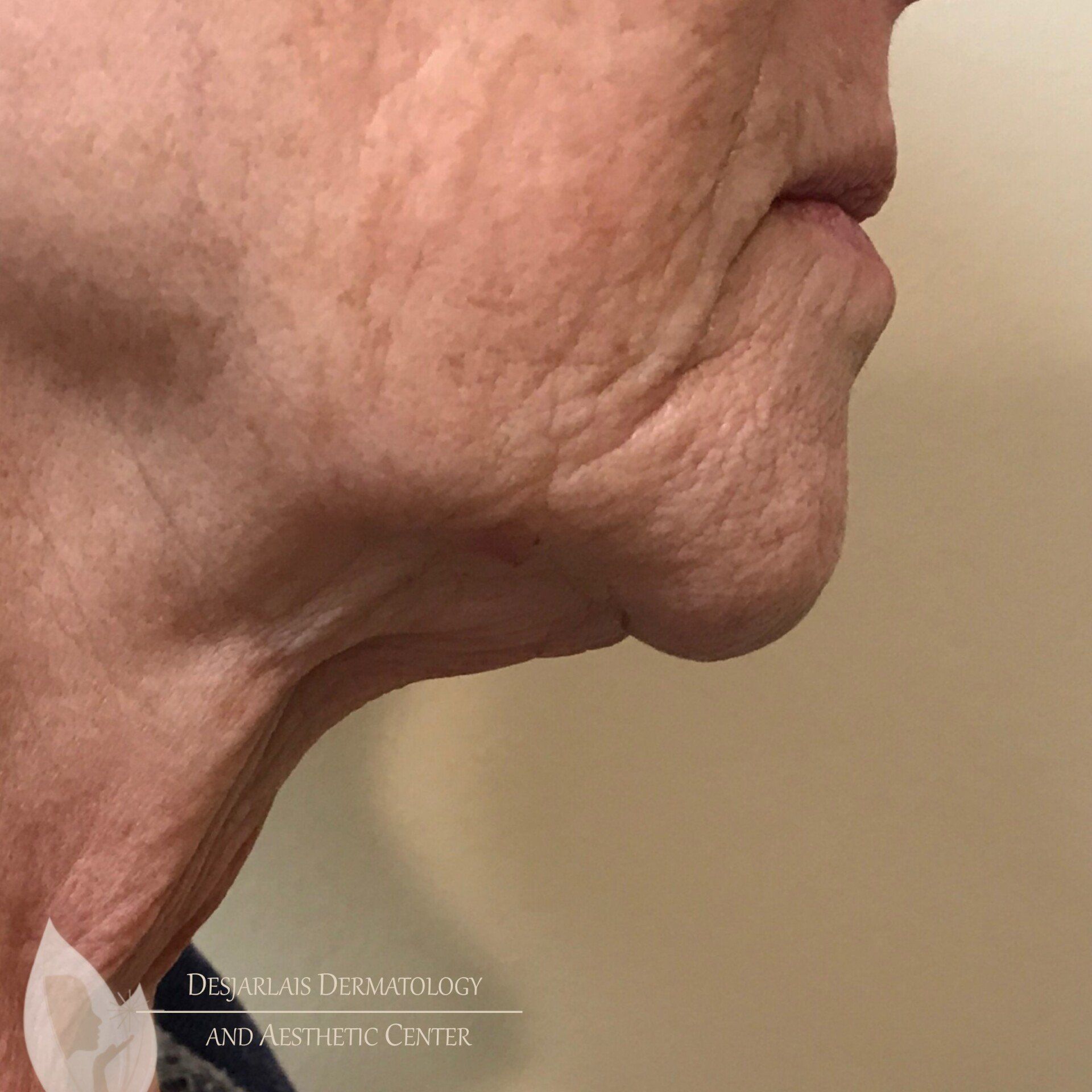 Ultra Morpheus Before Image at Dr. Desjarlais' Office in Adrian, MI